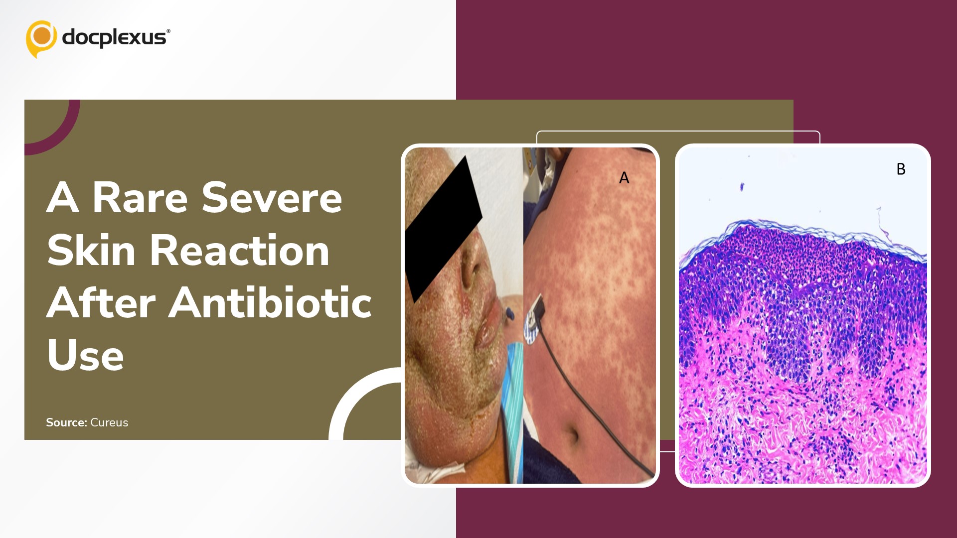 Diagnose This Rare, Life-Threatening Skin Reaction Following Antibiotic Use