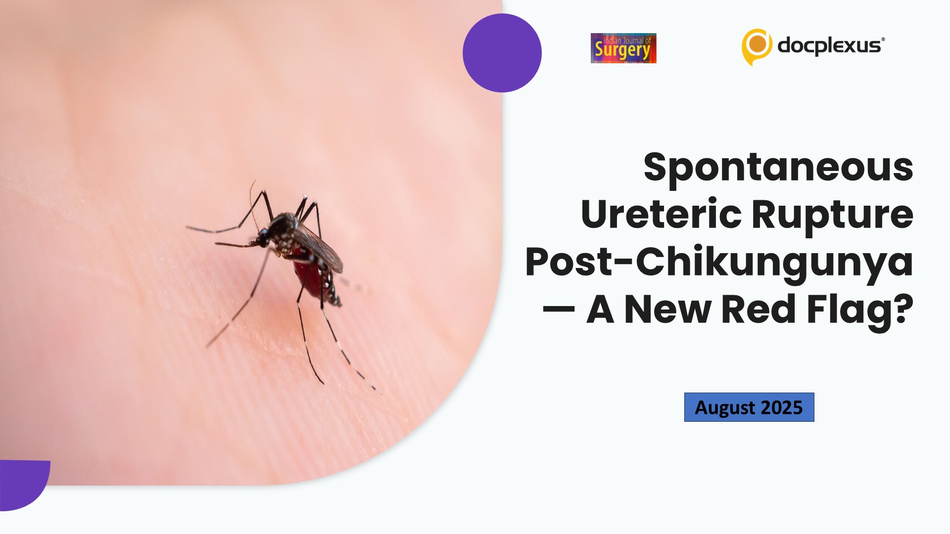 Spontaneous Ureteric Rupture Post-Chikungunya — A New Red Flag?