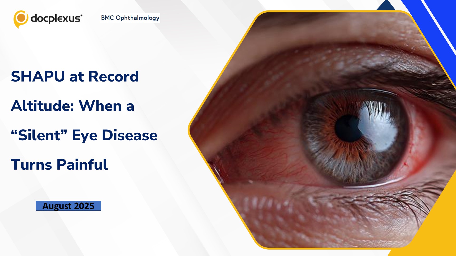 SHAPU at Record Altitude: When a “Silent” Eye Disease Turns Painful