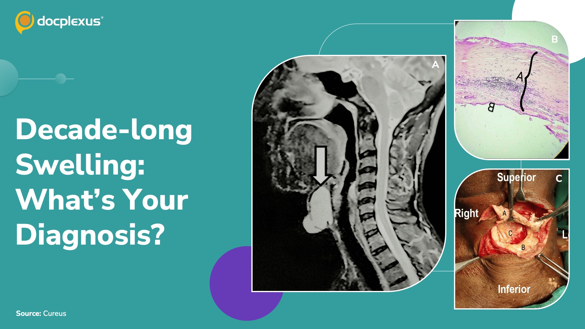 When a Neck Lump Isn’t What It Seems