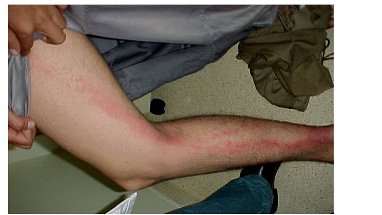 Erysipelas: Recognizing and Managing a Serious Skin Infection