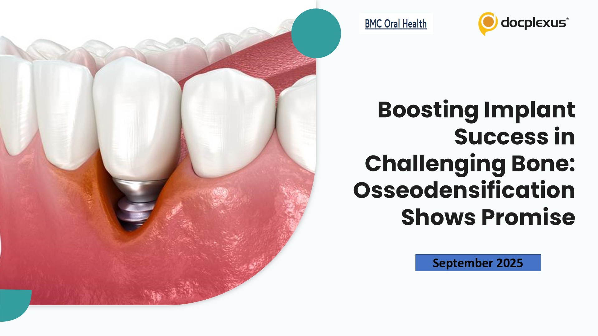 Boosting Implant Success in Challenging Bone: Osseodensification Shows Promise