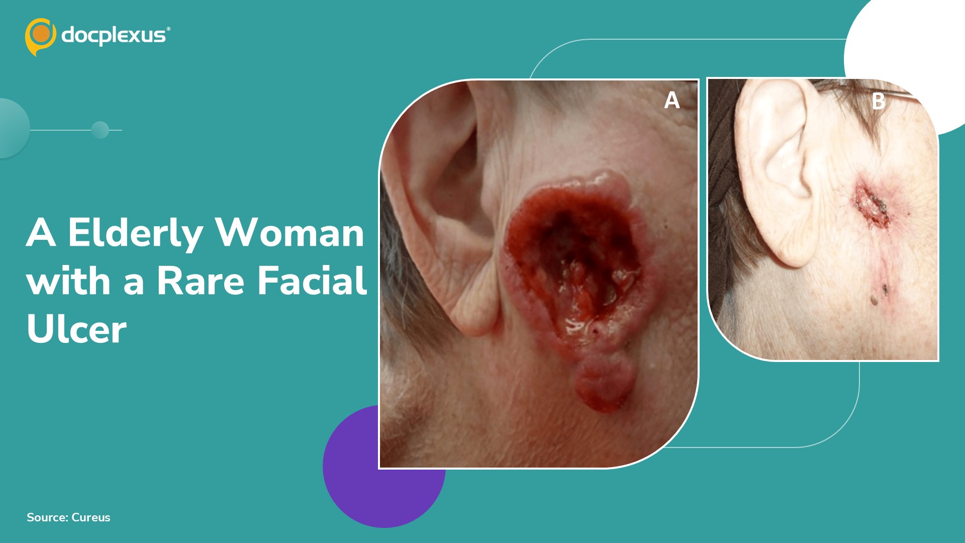 A Rare Ulcerated Facial Lesion in an Elderly Woman