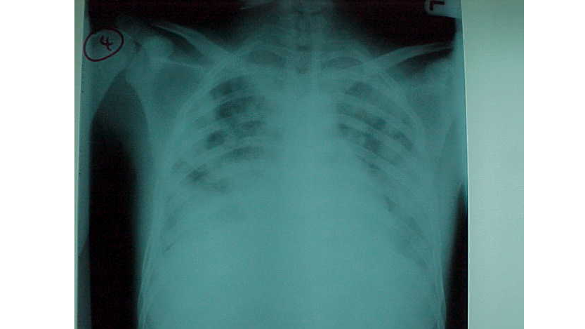 Acute Respiratory Distress Syndrome (ARDS): A Critical Emergency with High Mortality