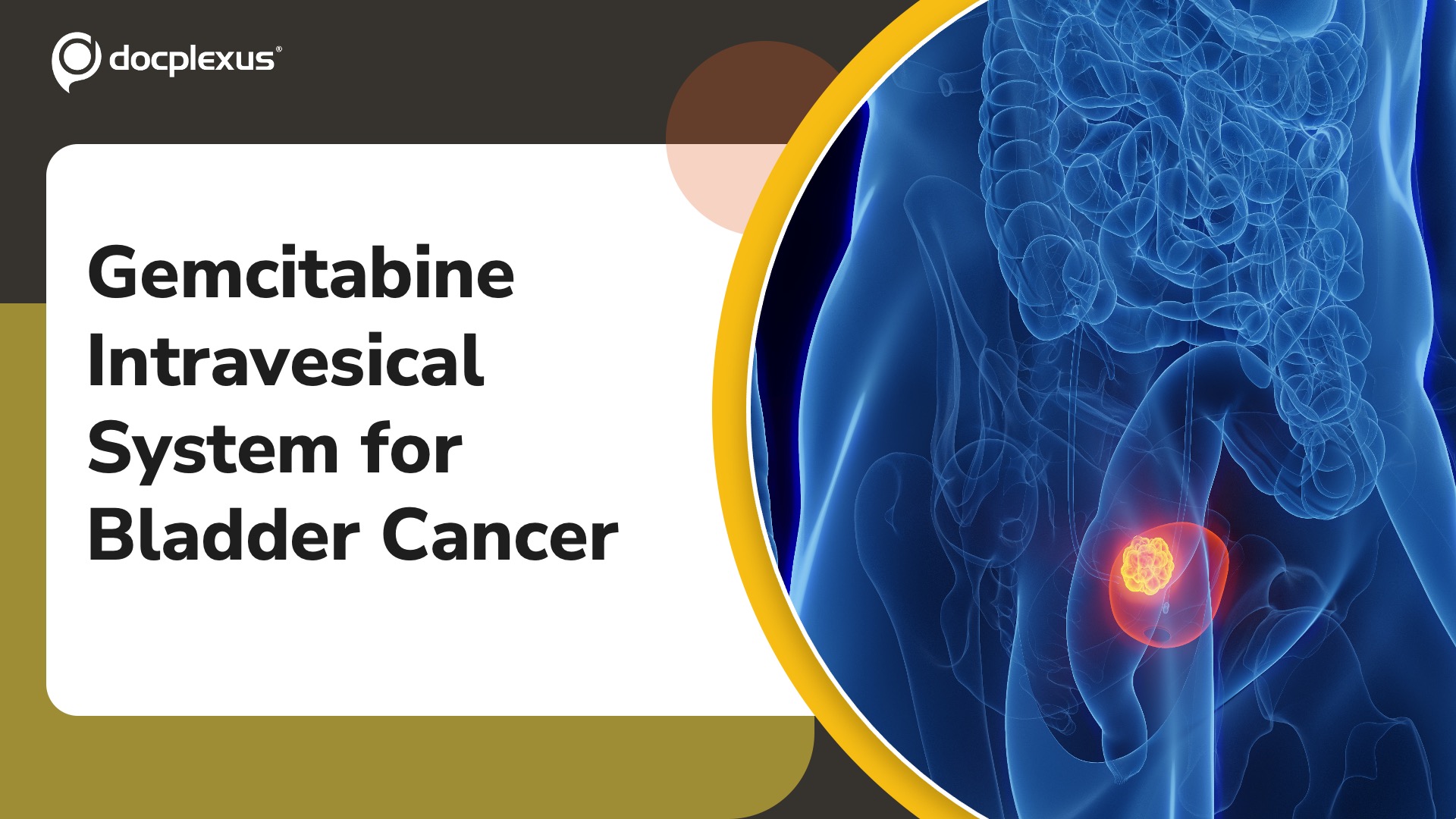 USFDA Approves Gemcitabine Intravesical System for Bladder Cancer