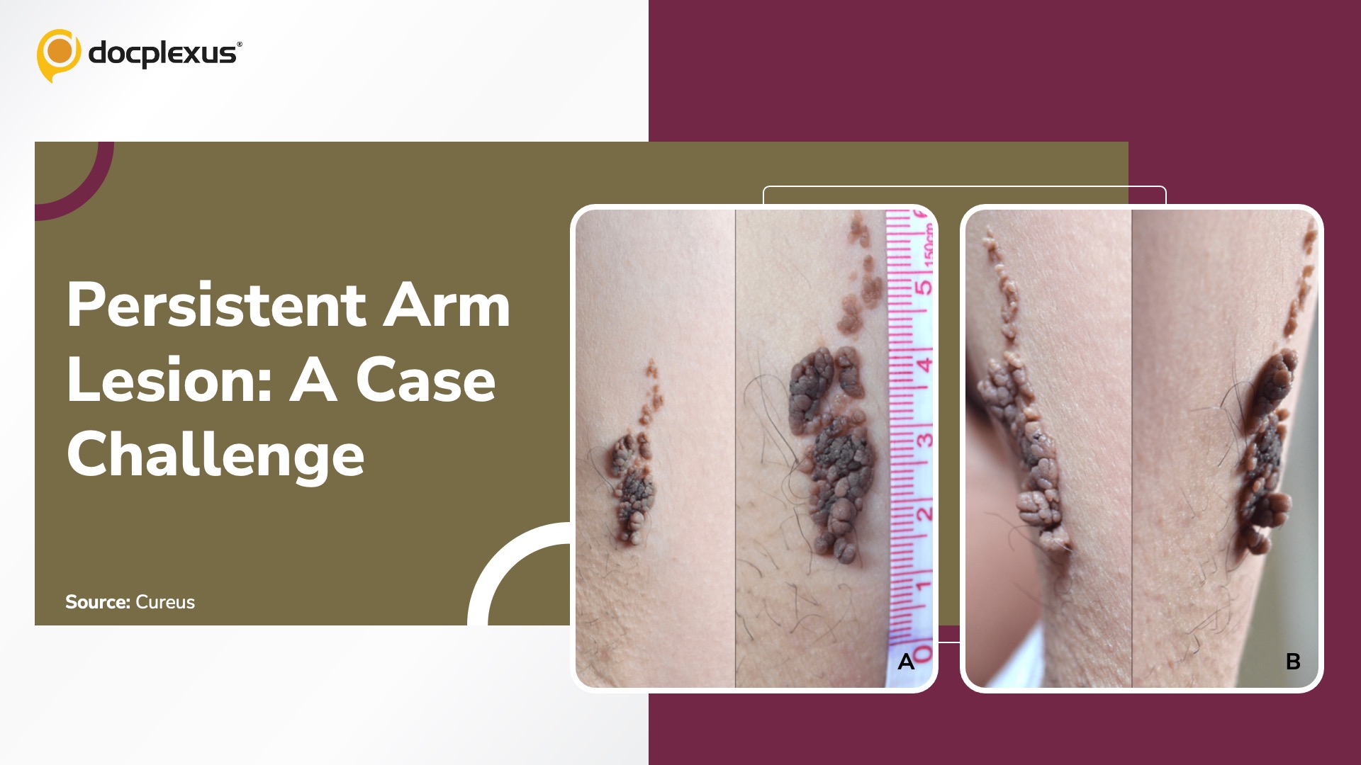 Rare Congenital Arm Lesion: What’s Your Diagnosis?