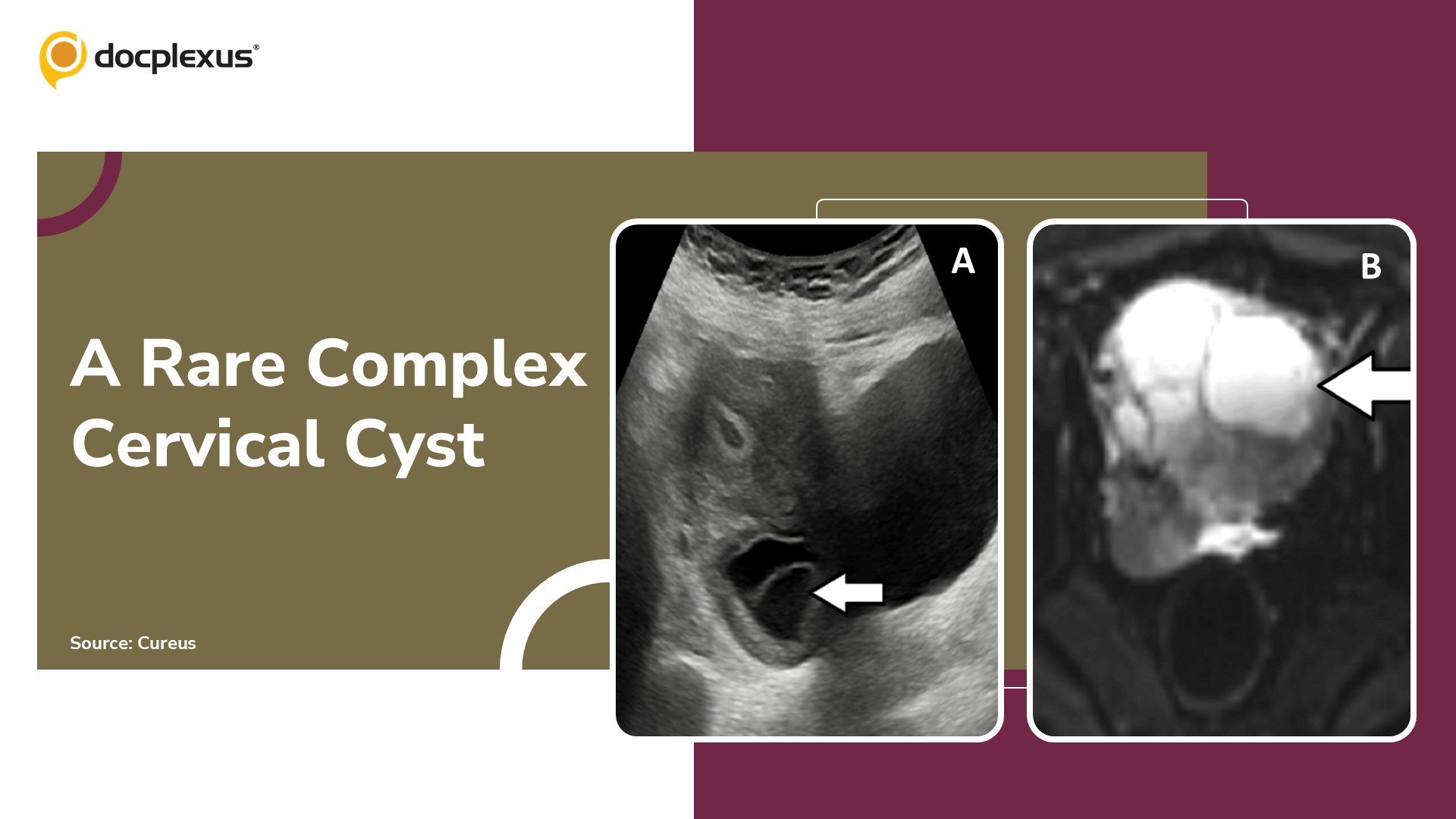 An Uncommon Presentation of a Complex Cervical Cyst