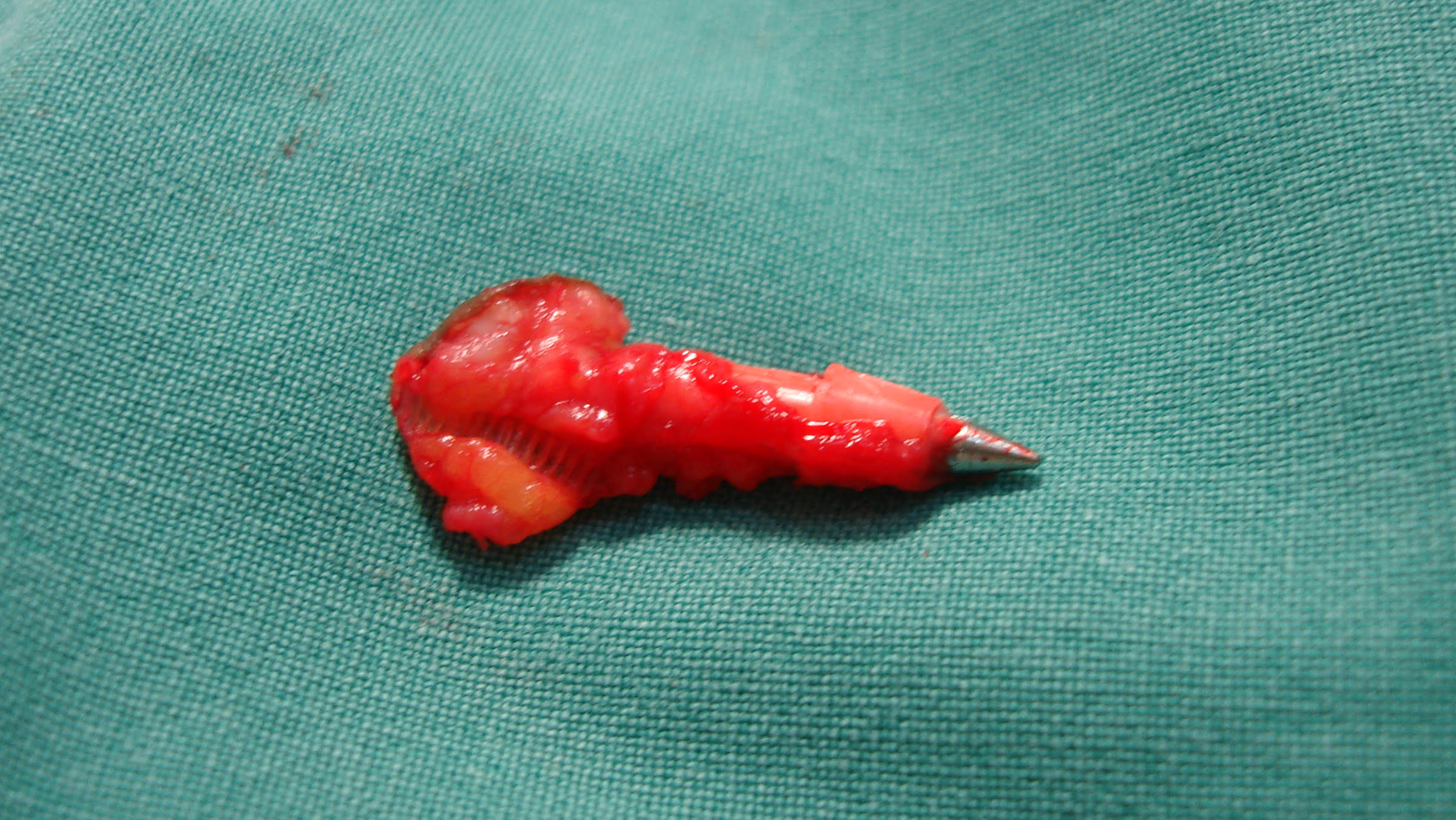 Foreign Body Granuloma with a Twist: Ball Pen Case