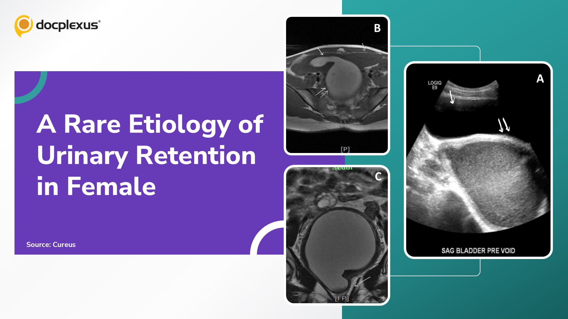 Diagnose Atypical Urinary Retention in Adolescent Female