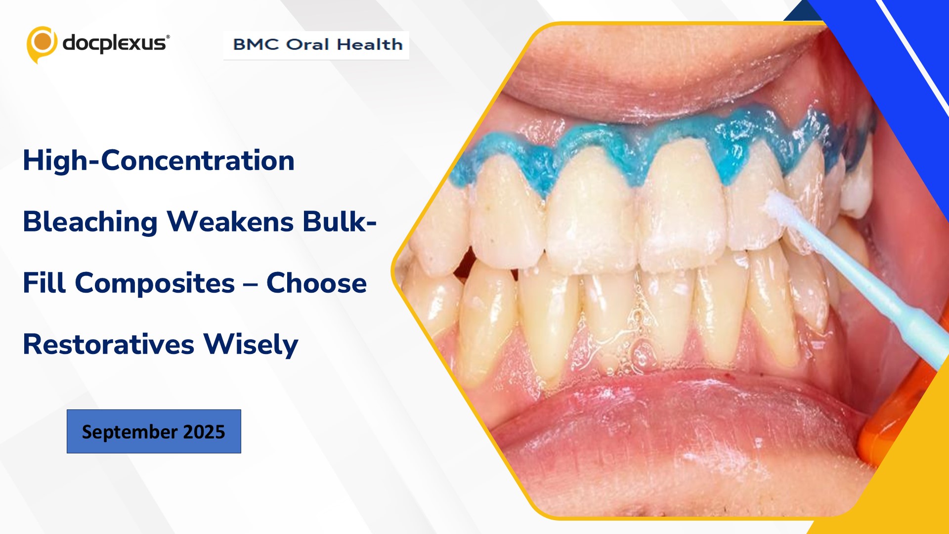 High-Concentration Bleaching Weakens Bulk-Fill Composites – Choose Restoratives Wisely