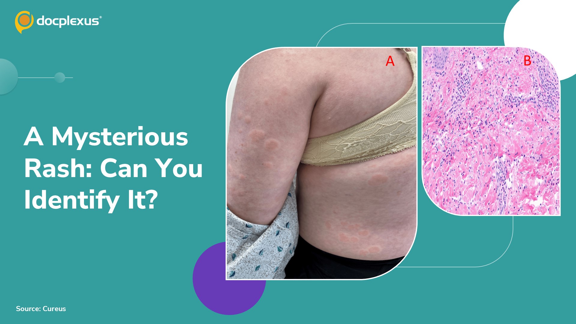 Mystery Rash in an Adult: Can You Identify the Rare Skin Condition?