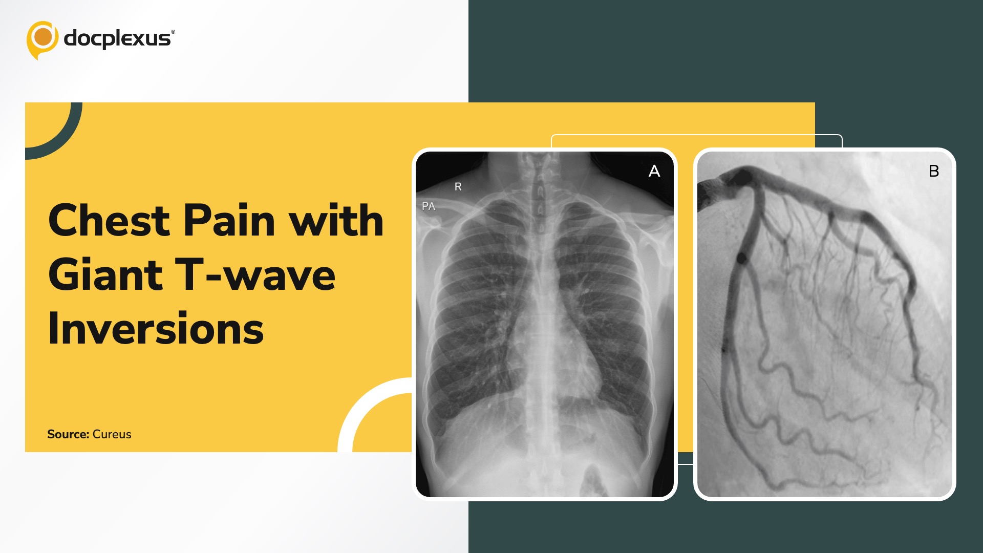 A Rare Cause of Chest Pain and Normal Angiogram in a Young Adult