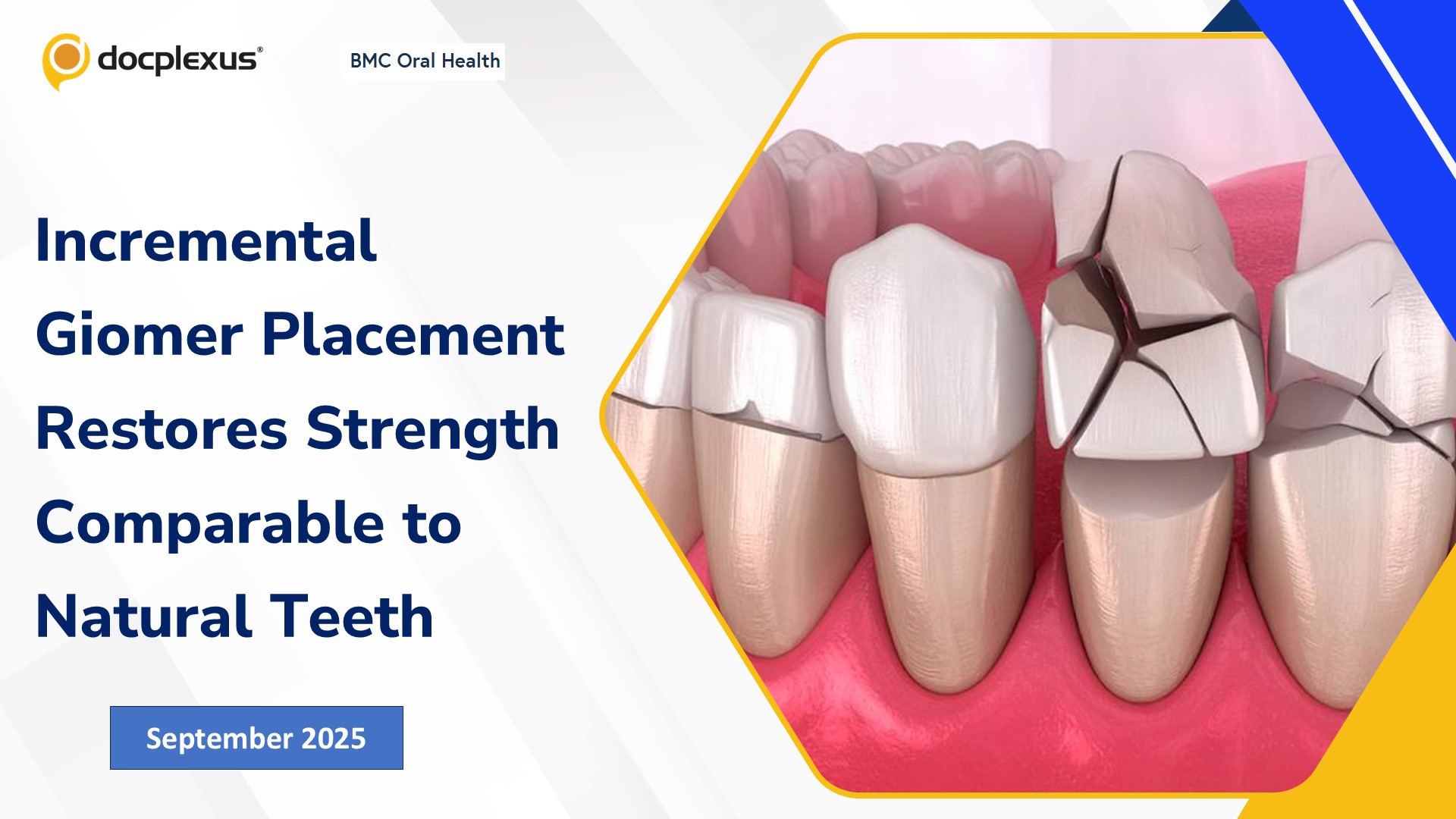 Incremental Giomer Placement Restores Strength Comparable to Natural Teeth