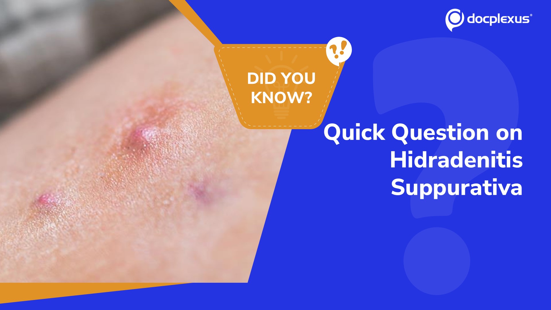Hidradenitis Suppurativa: Key Insight & Quick Quiz