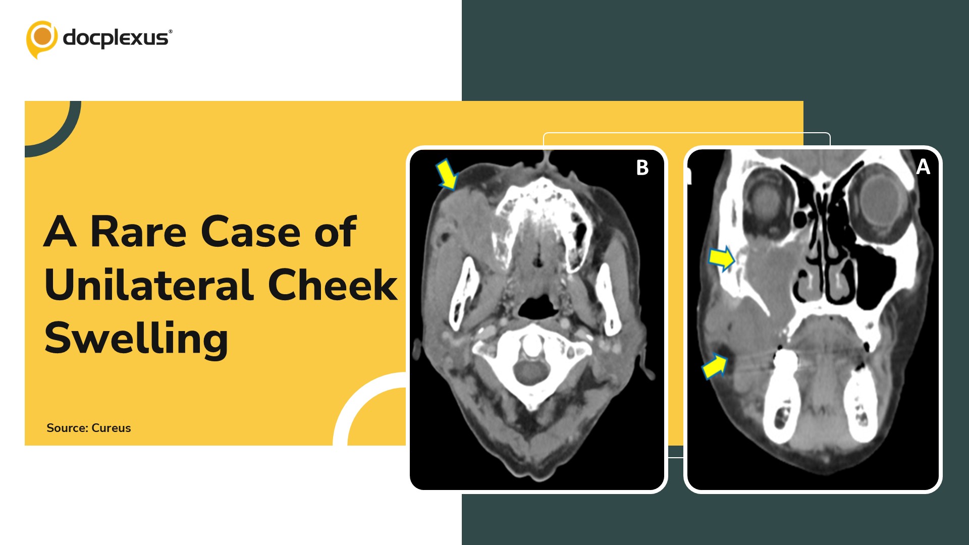 Diagnose Atypical Cheek Swelling in an Elderly Man