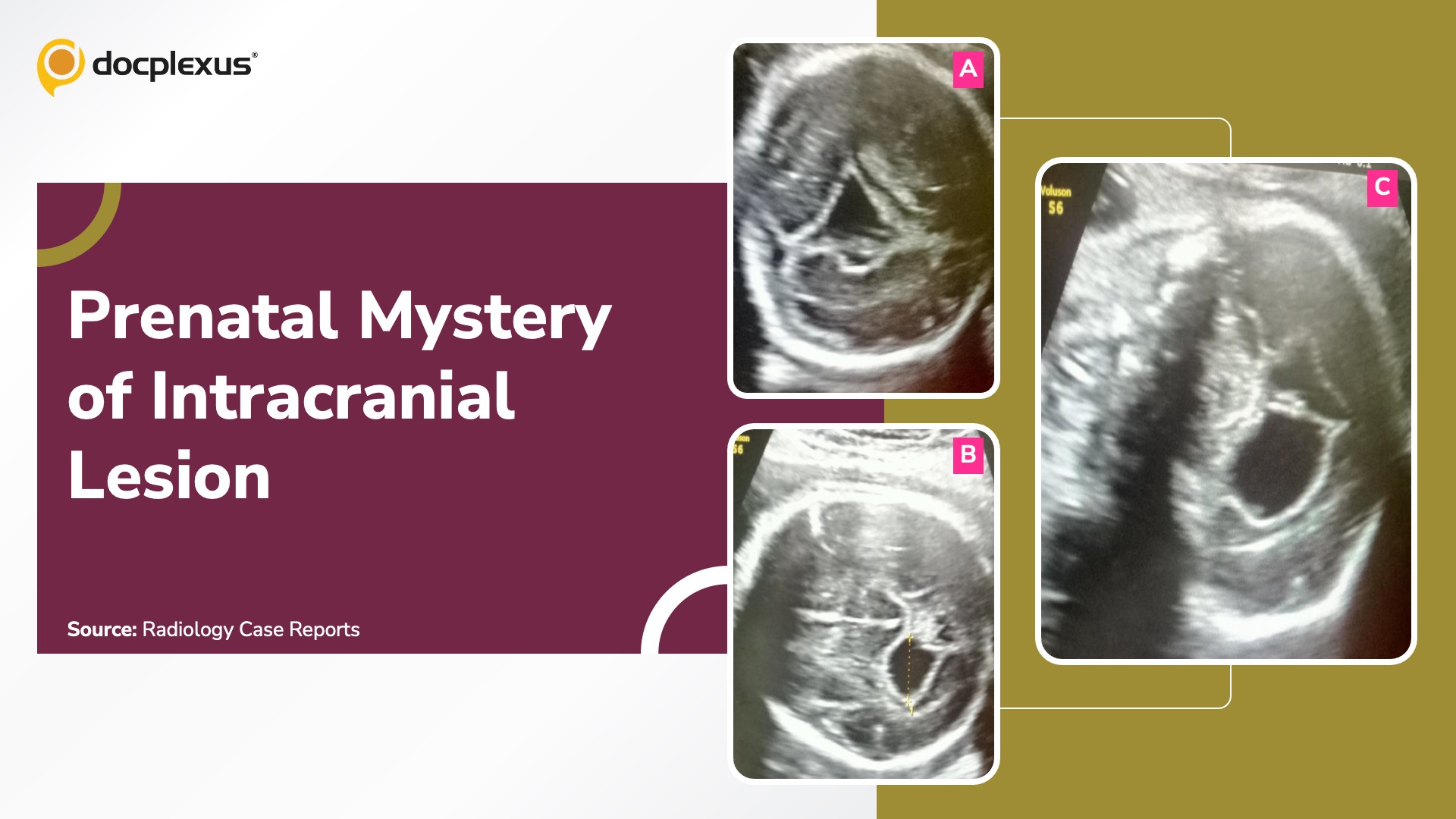 A Rare Case of Fetal Intracranial Lesion