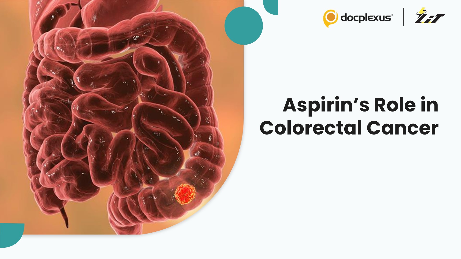 Could Aspirin Be a Game-Changer in Colorectal Cancer Care?