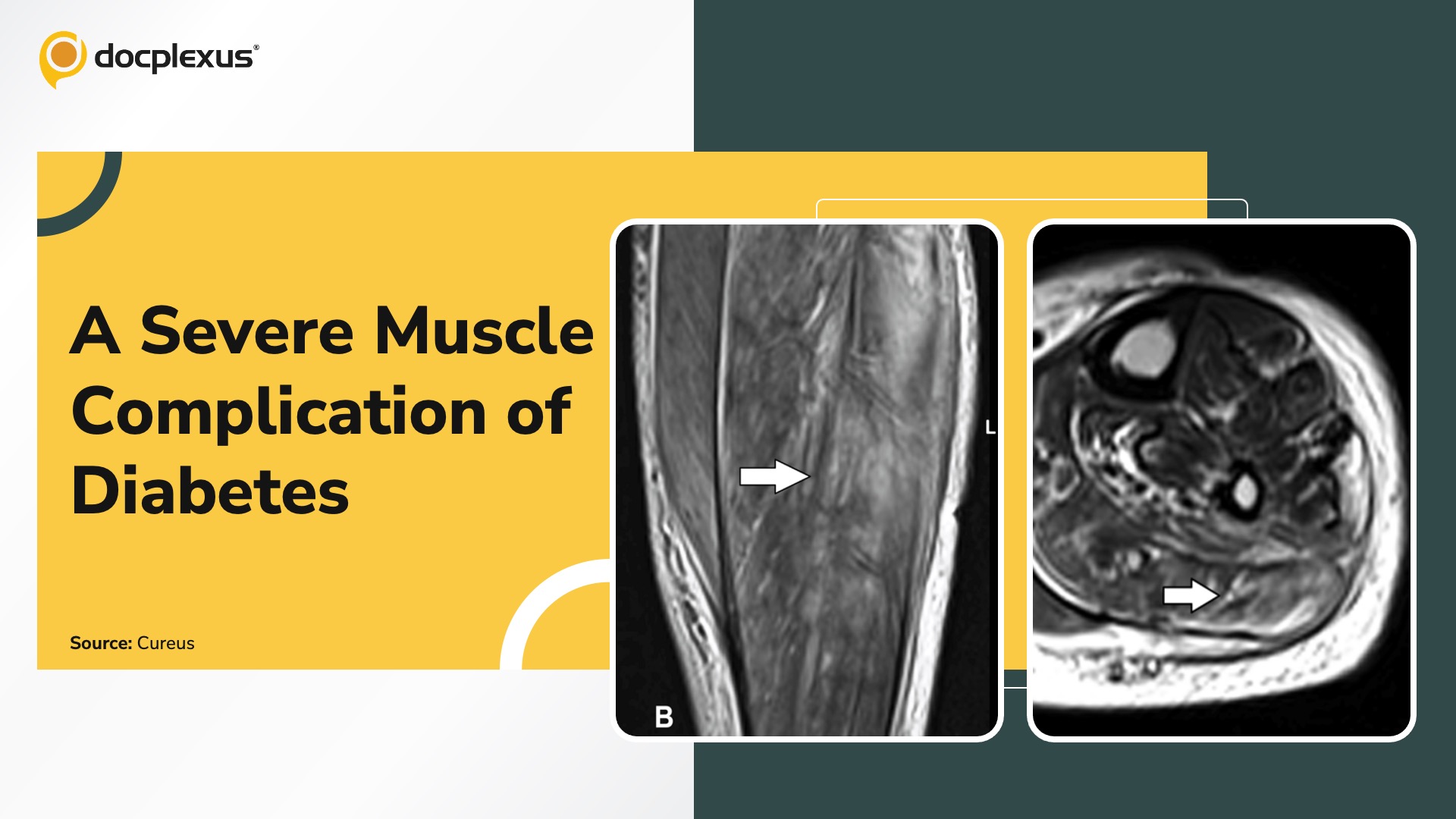 Can You Solve This Case of Severe Calf Pain in a Diabetic Patient?