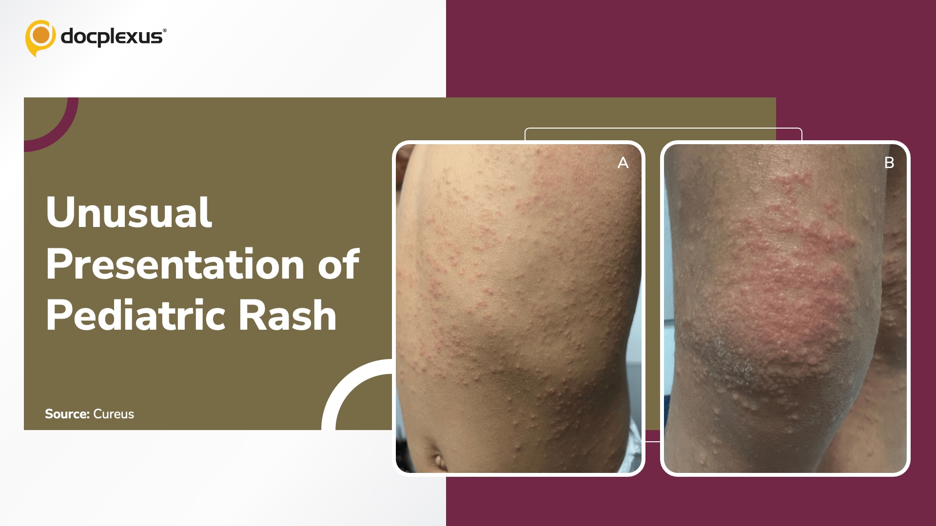 A Pediatric Case of Symmetrical Papulovesicular Rash