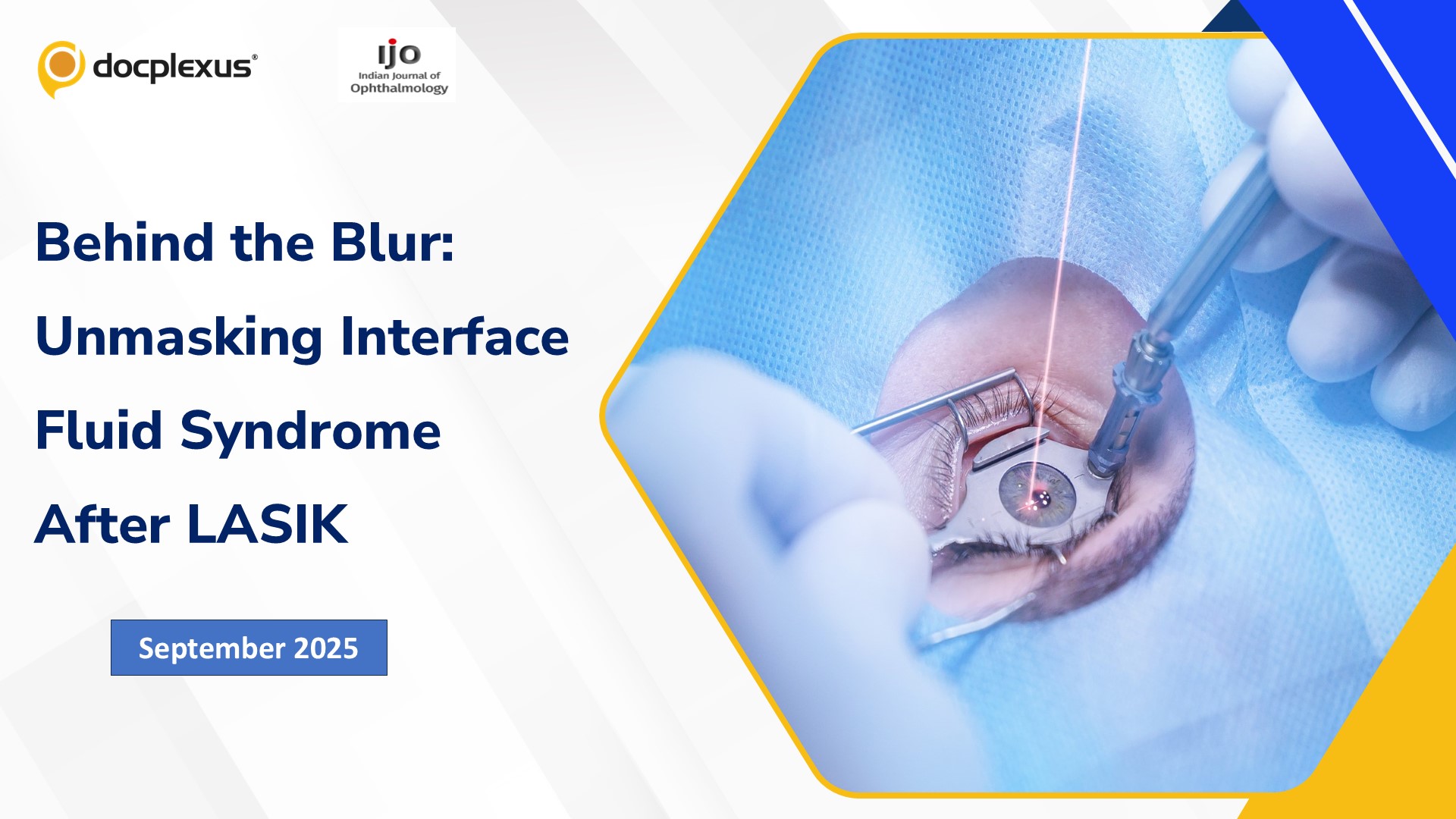 Behind the Blur: Unmasking Interface Fluid Syndrome After LASIK