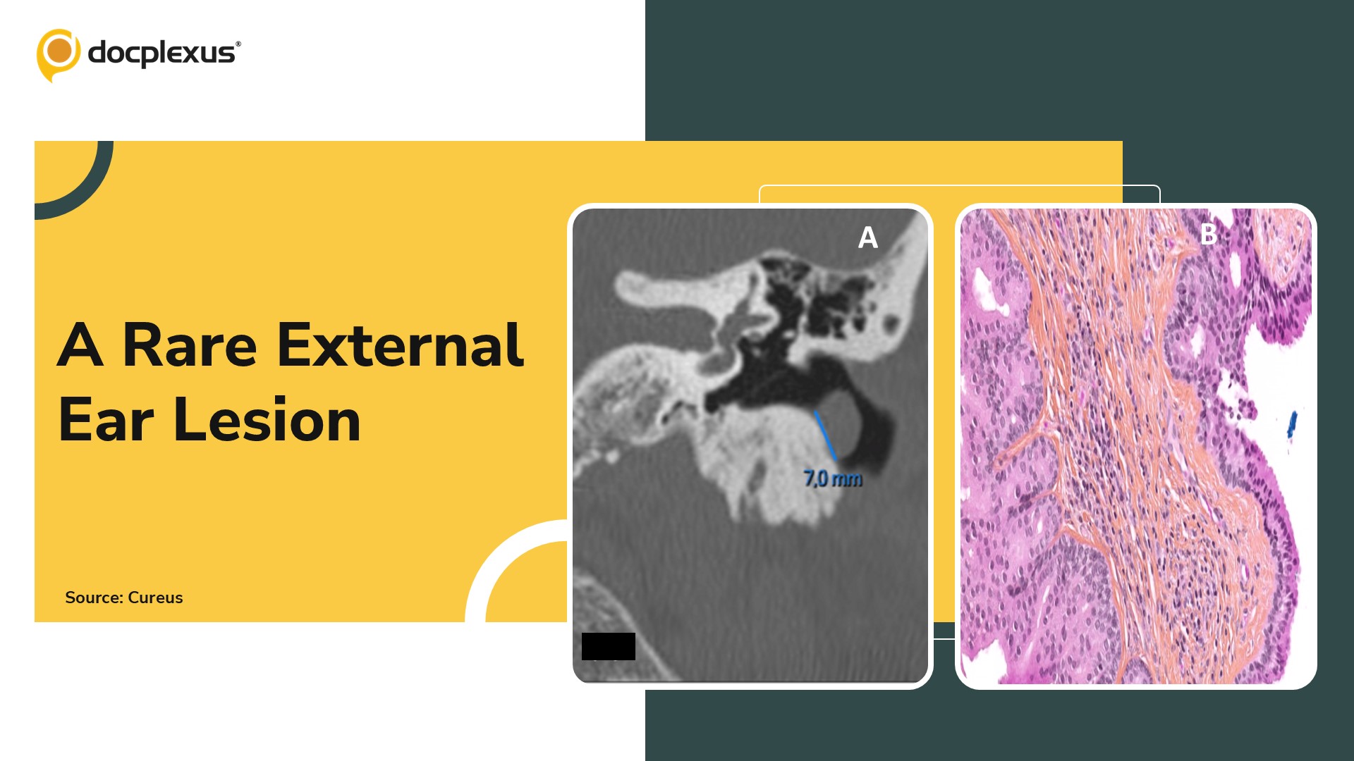 Diagnosis of an External Ear Canal Lesion – Solve This Case