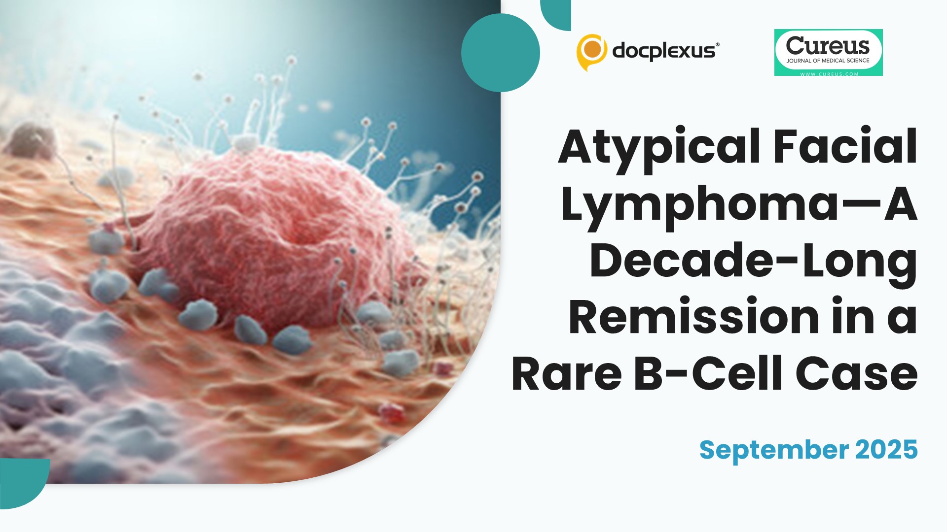 Atypical Facial Lymphoma—A Decade-Long Remission in a Rare B-Cell