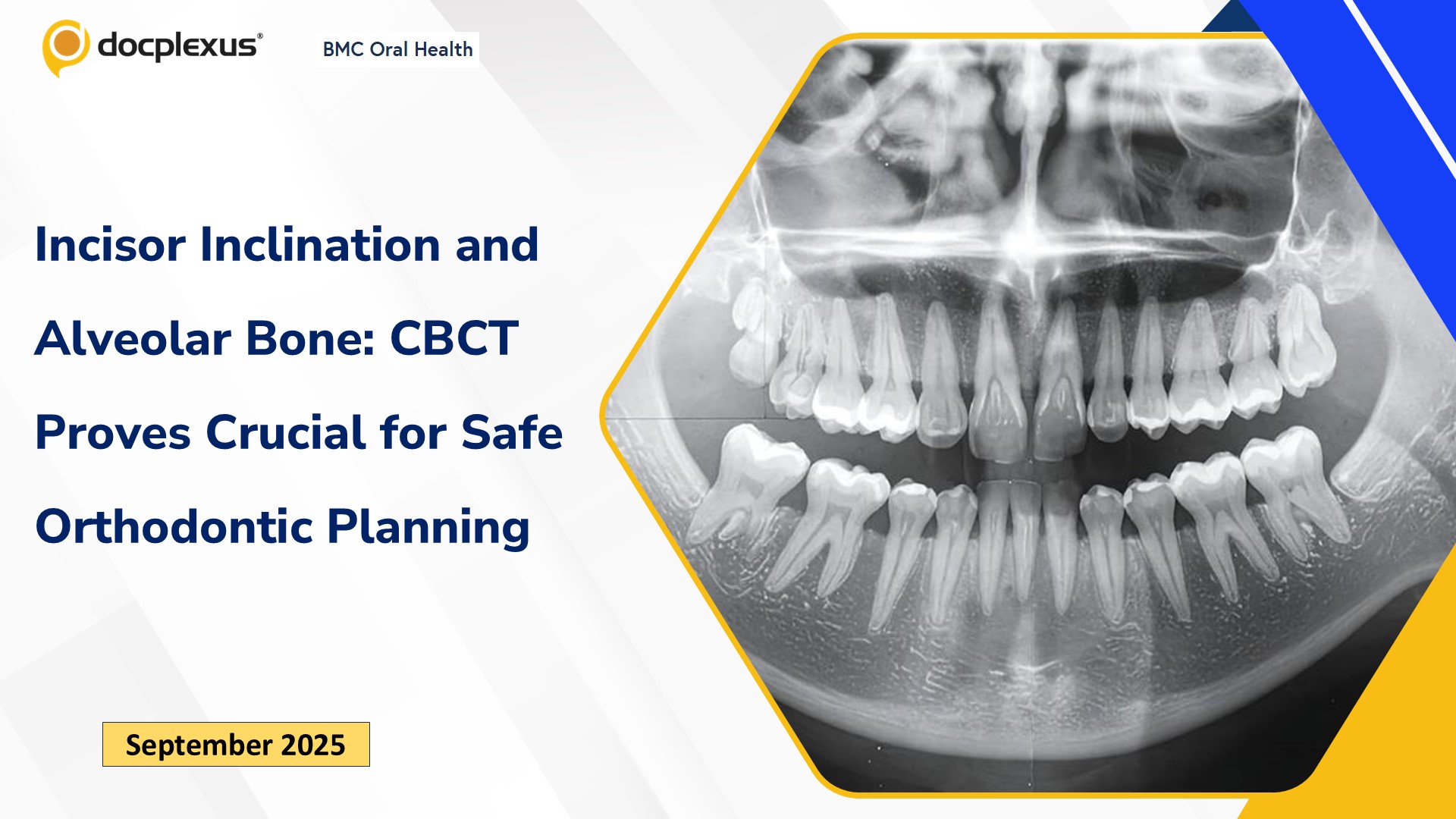 Incisor Inclination and Alveolar Bone: CBCT Proves Crucial for Safe Orthodontic Planning
