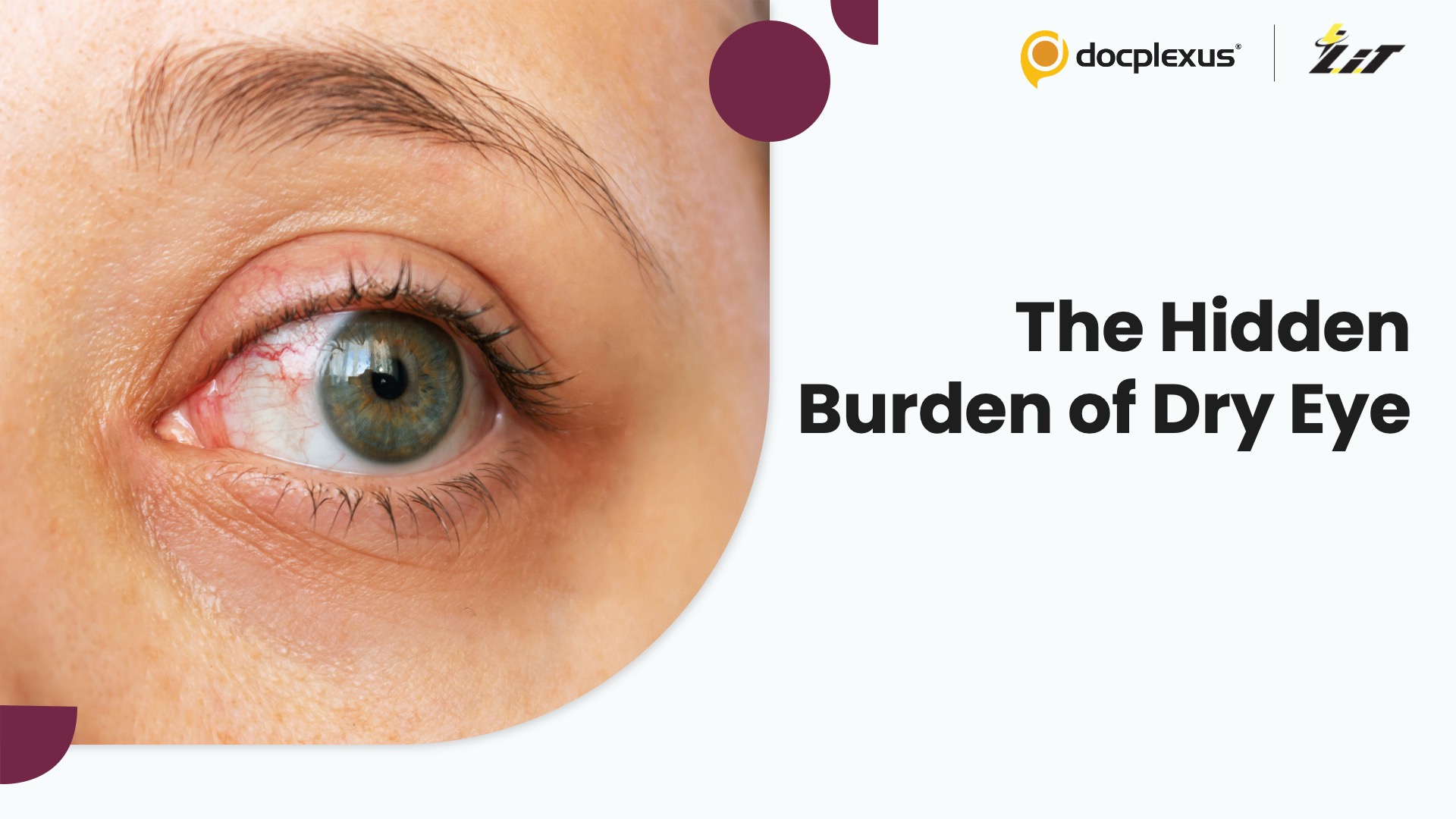 Dry Eye Is Everywhere, But Few Patients Get Diagnosed
