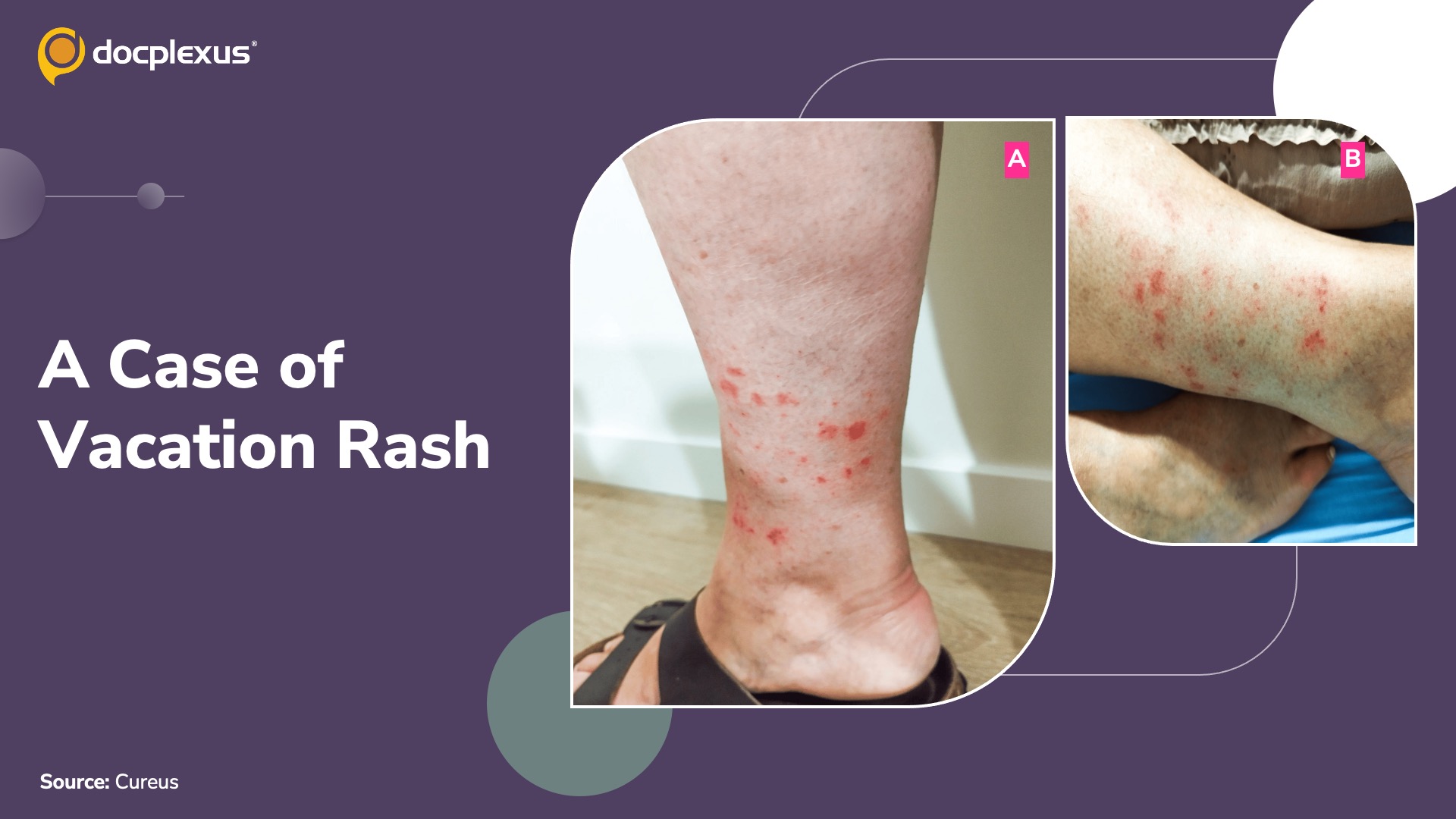 Can You Diagnose This Rash Developed After Vacation?