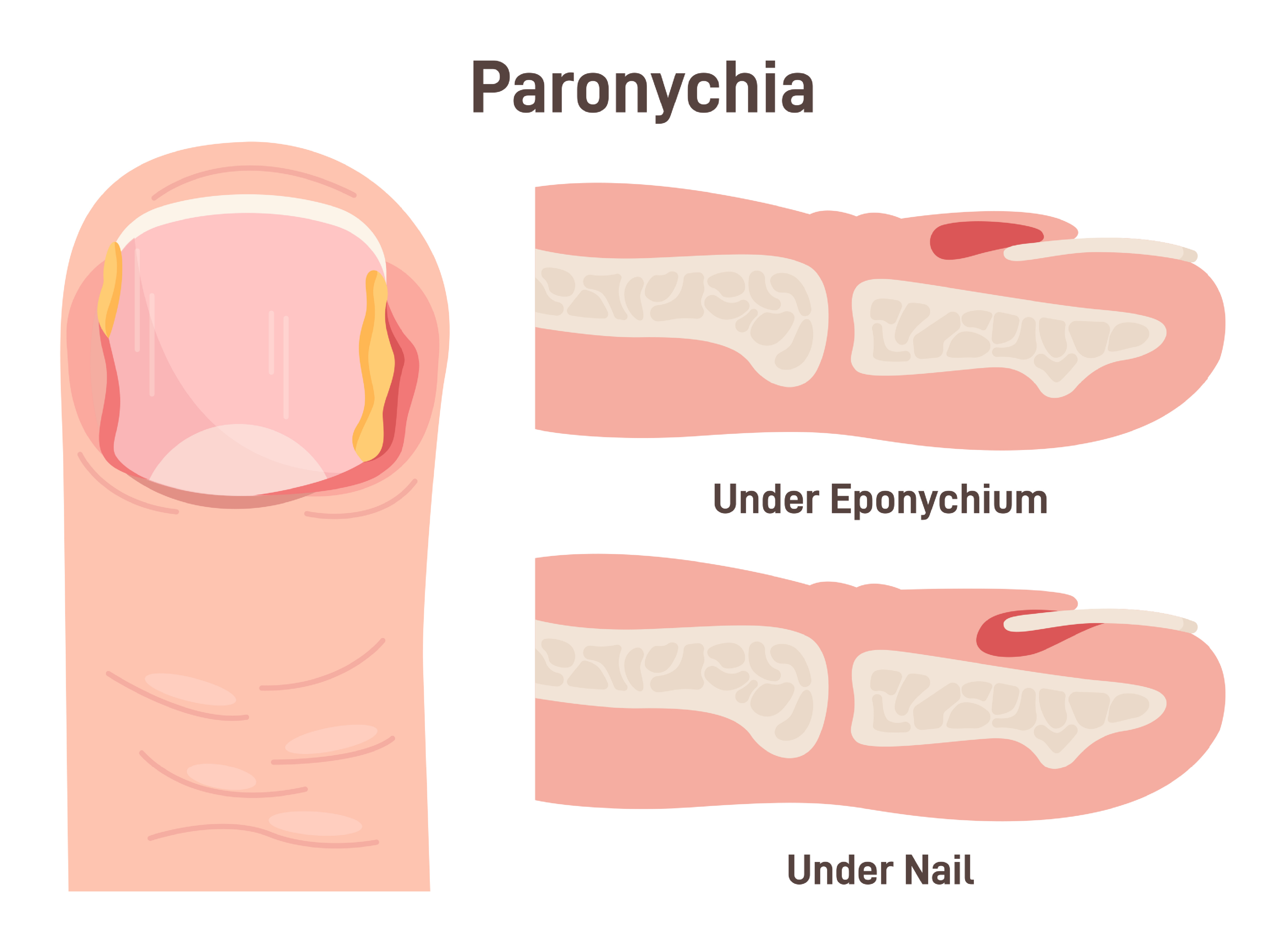 Paronychia: Painful Nail Fold Infection