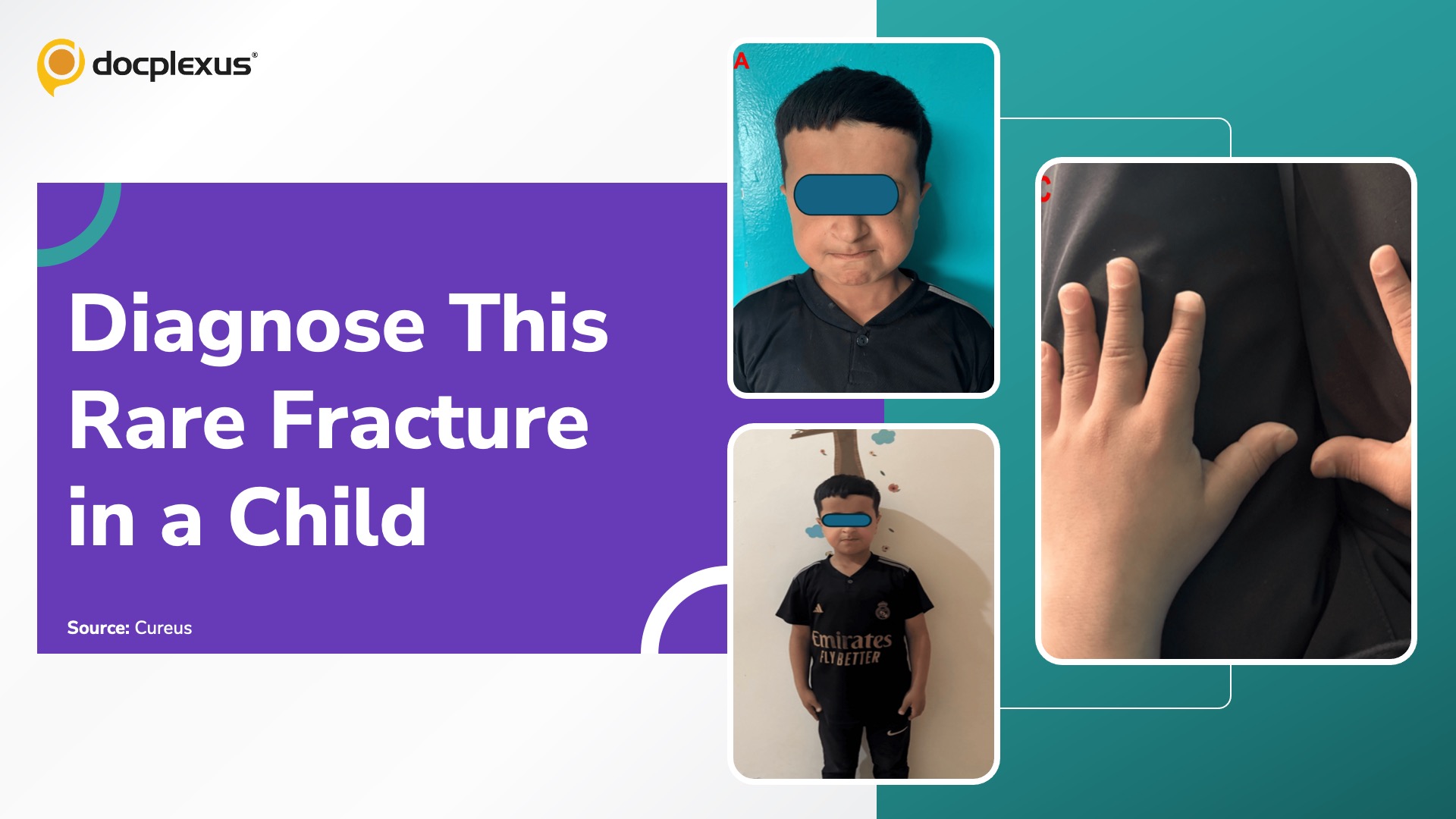 An Unusual Femoral Fracture in a Child