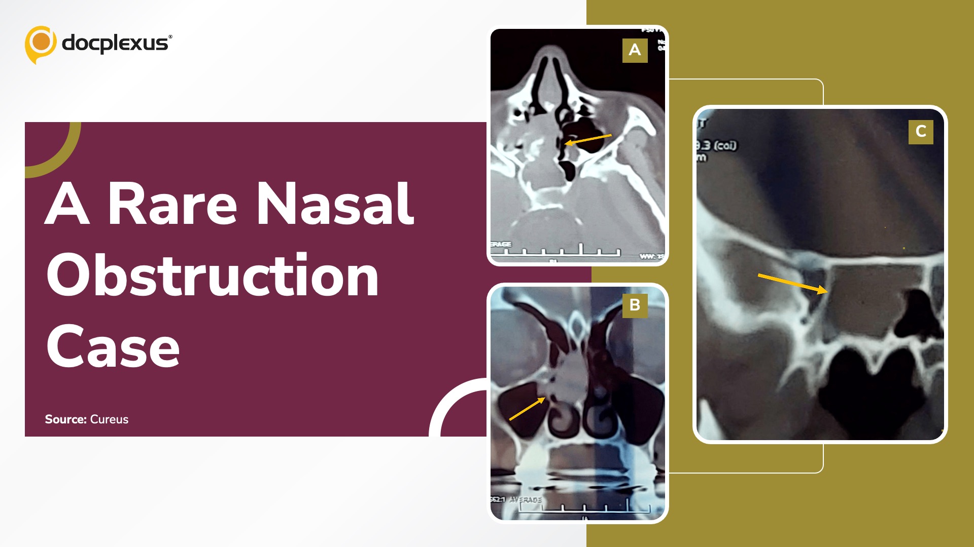 Eight Months of Nasal Obstruction — Can You Diagnose It?