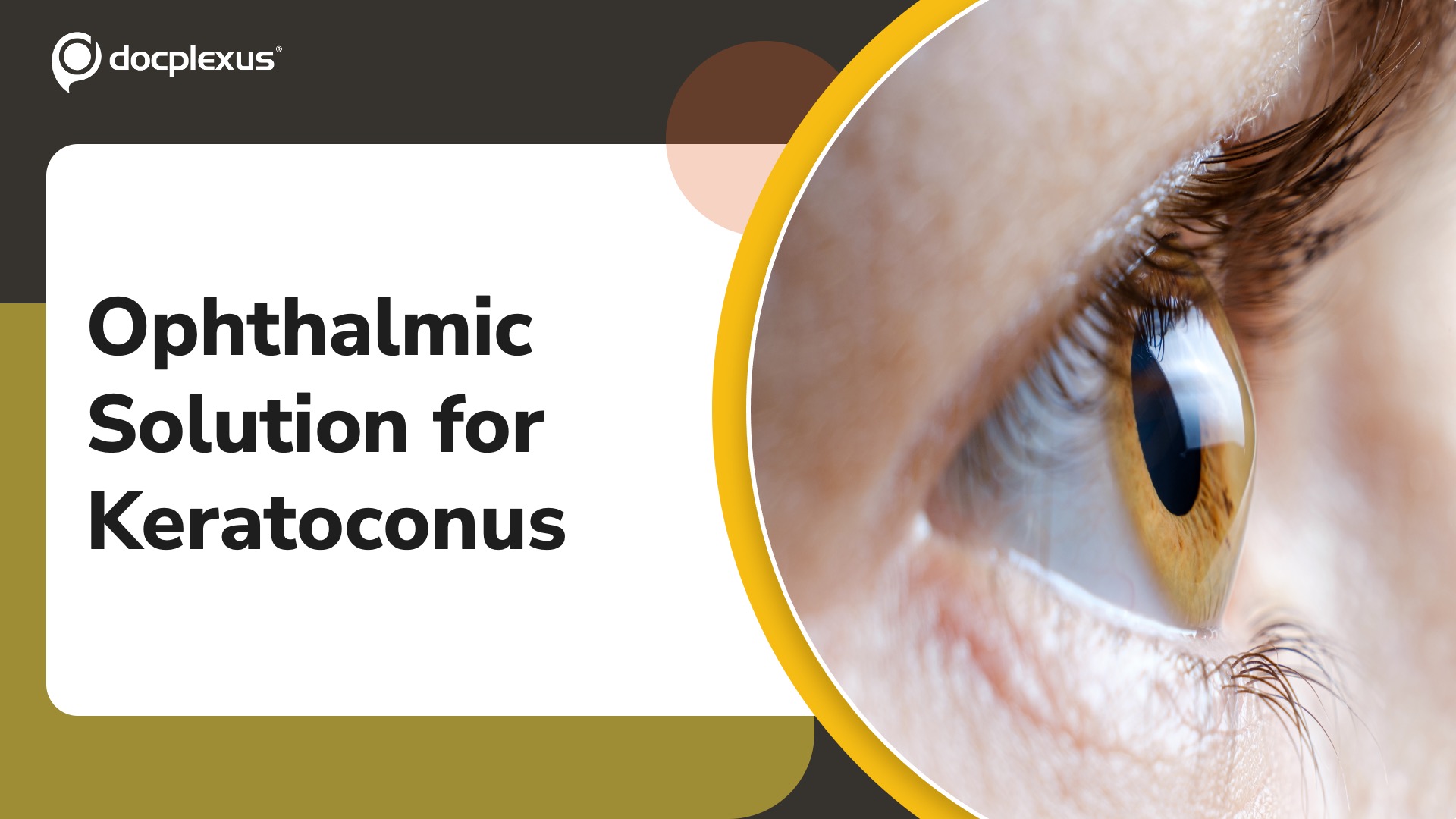 USFDA Approves Riboflavin 5’-phosphate Ophthalmic Solution for Keratoconus