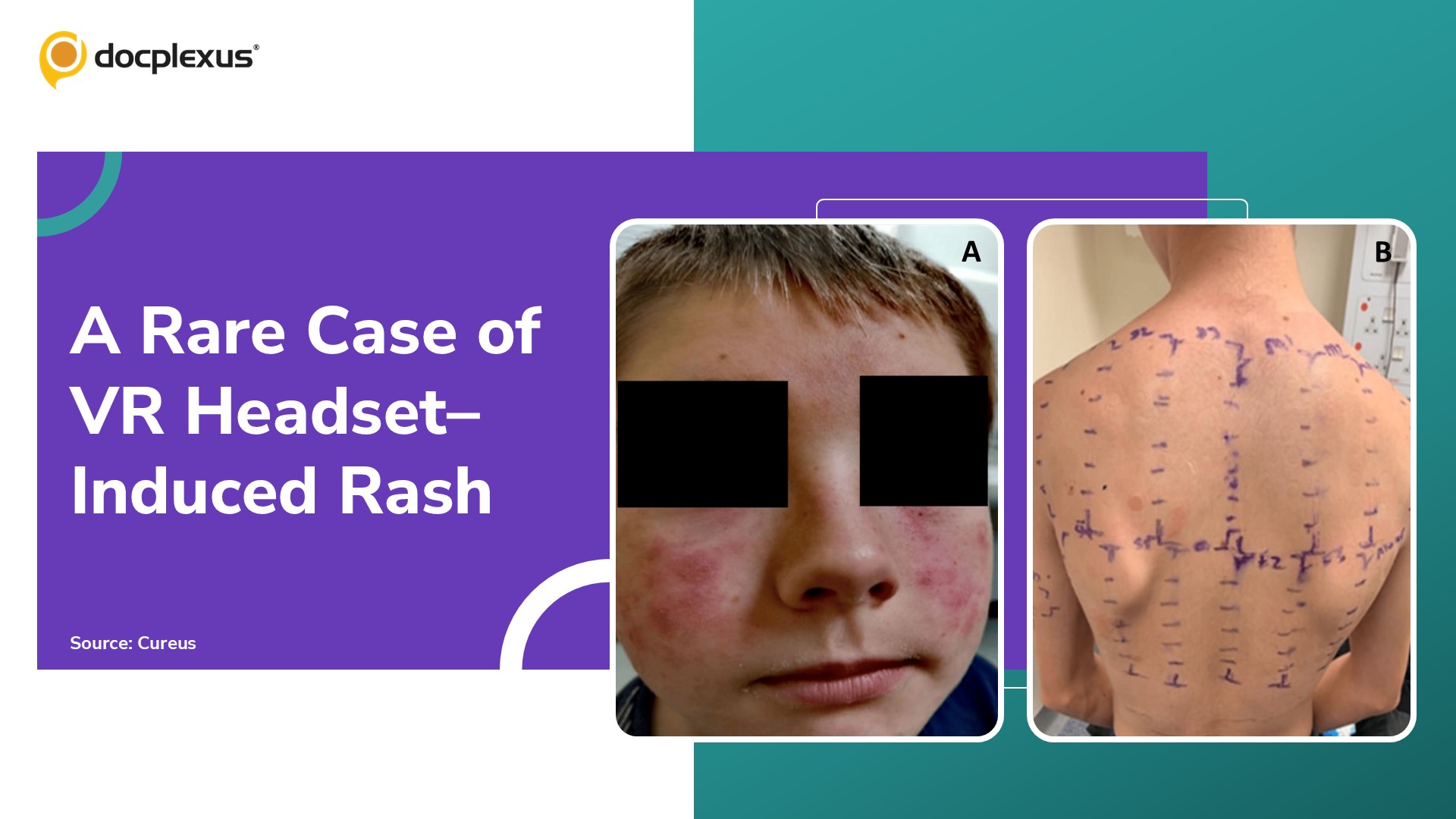 VR Headset–Induced Facial Rash: A New Dermatological Concern