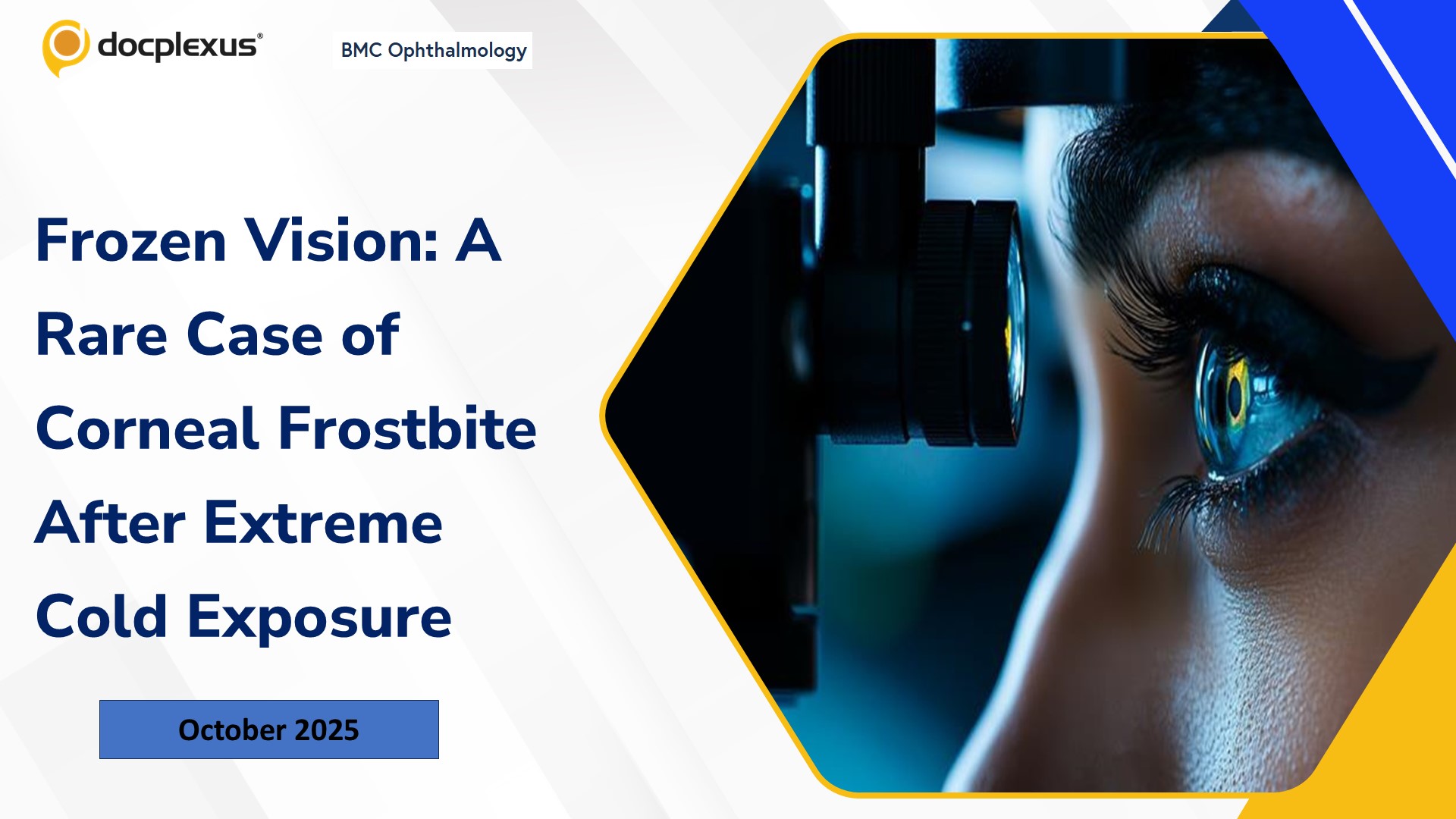 Frozen Vision: A Rare Case of Corneal Frostbite After Extreme Cold Exposure