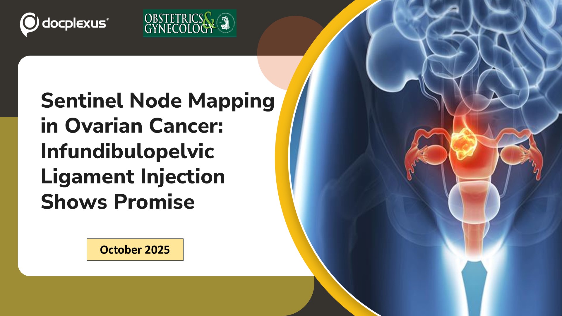 Sentinel Node Mapping in Ovarian Cancer: Infundibulopelvic Ligament Injection Shows Promise
