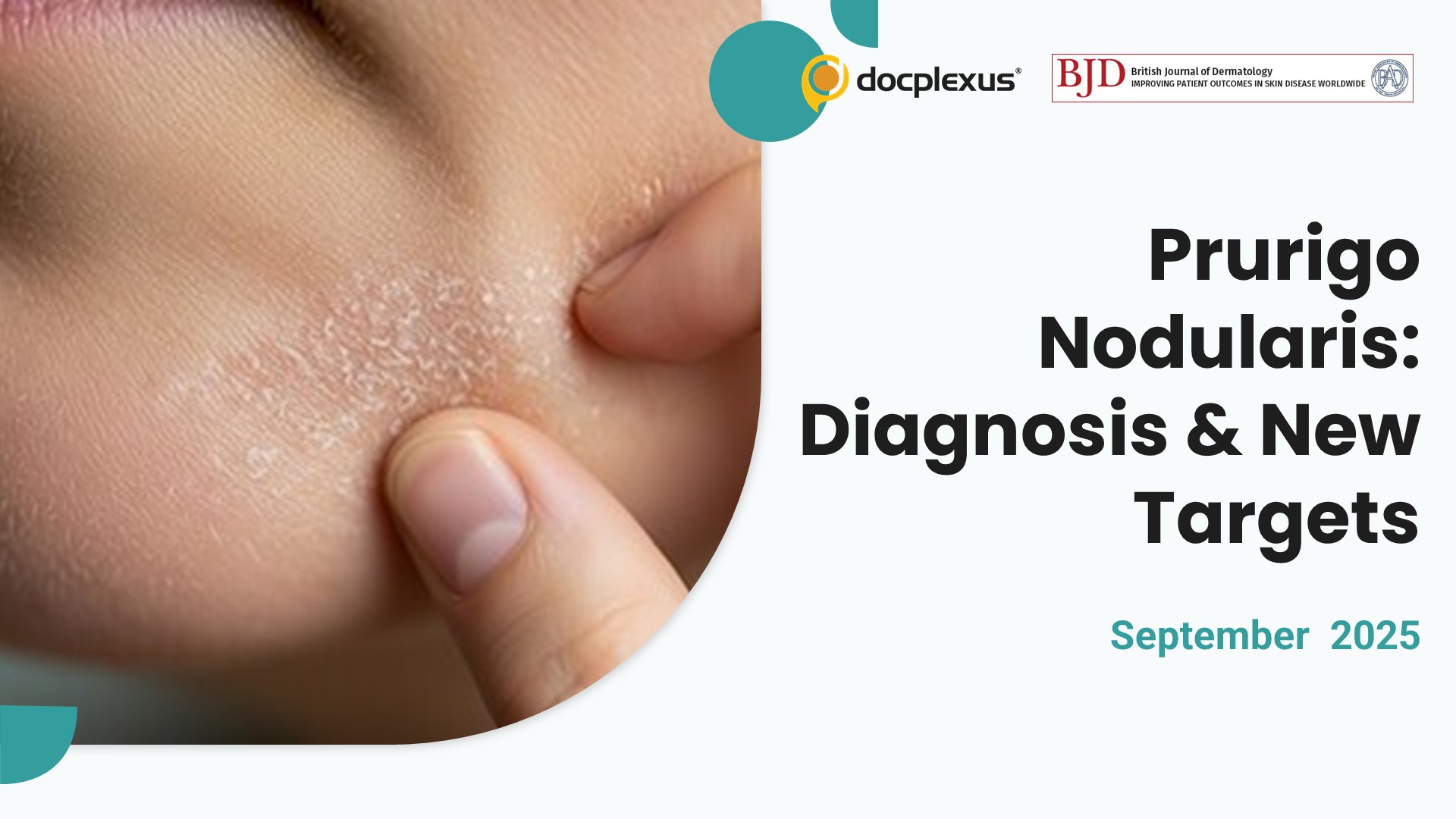 Unmasking Prurigo Nodularis: Diagnosis and Treatments Transform Outlook