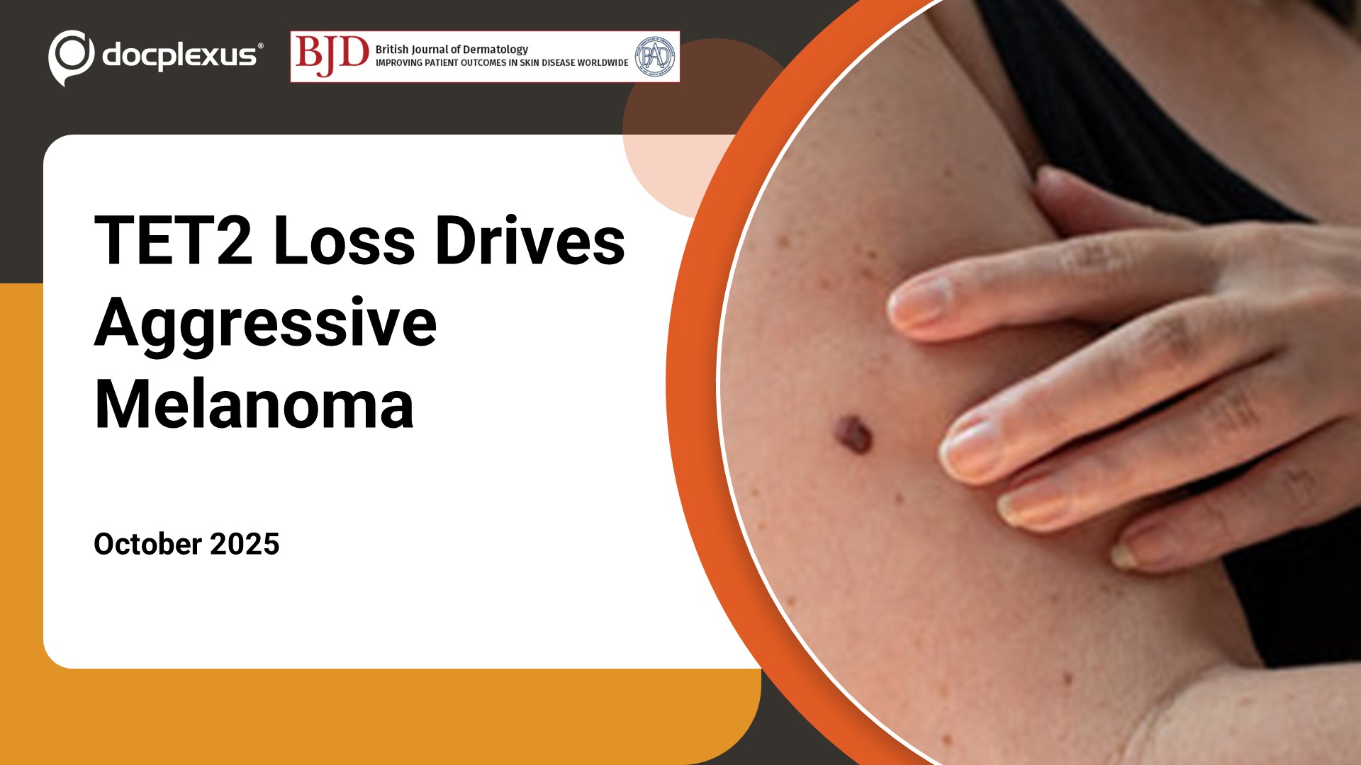 Unraveling the Molecular Blueprint of Melanoma Progression