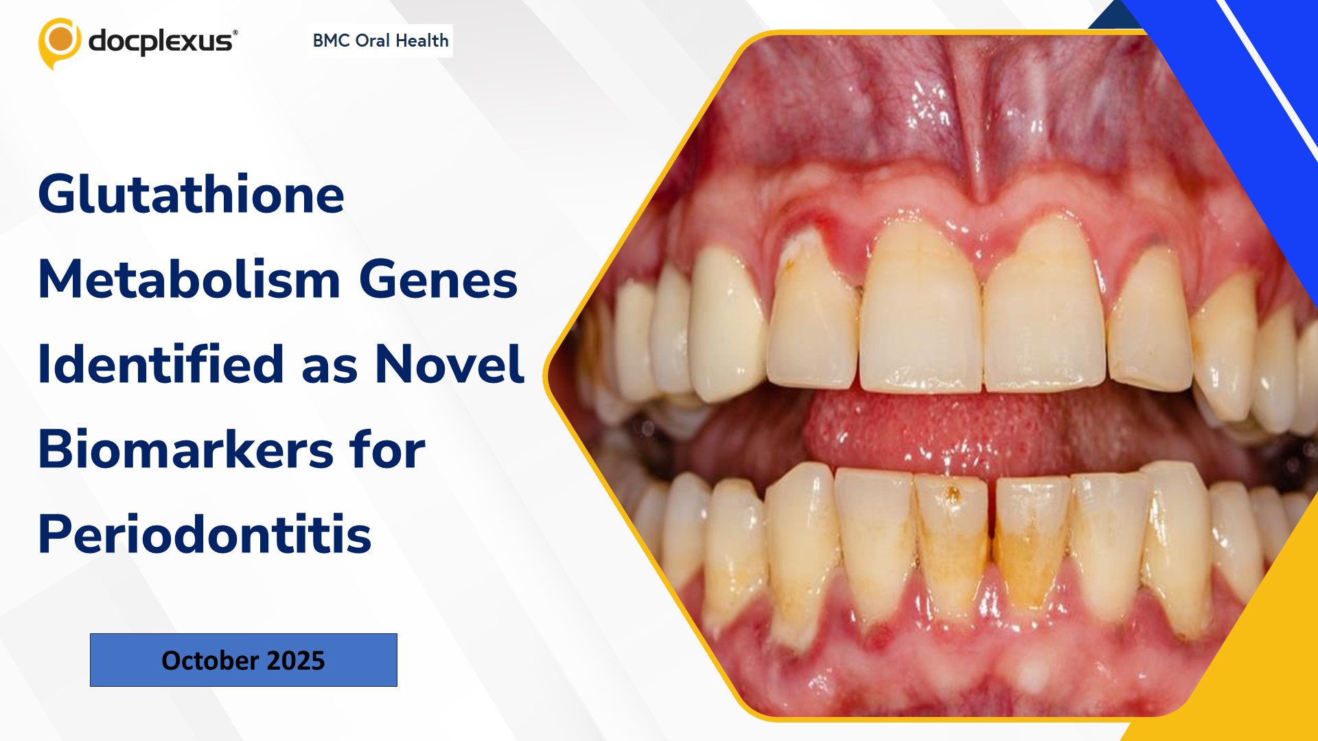 Glutathione Metabolism Genes Identified as Novel Biomarkers for Periodontitis