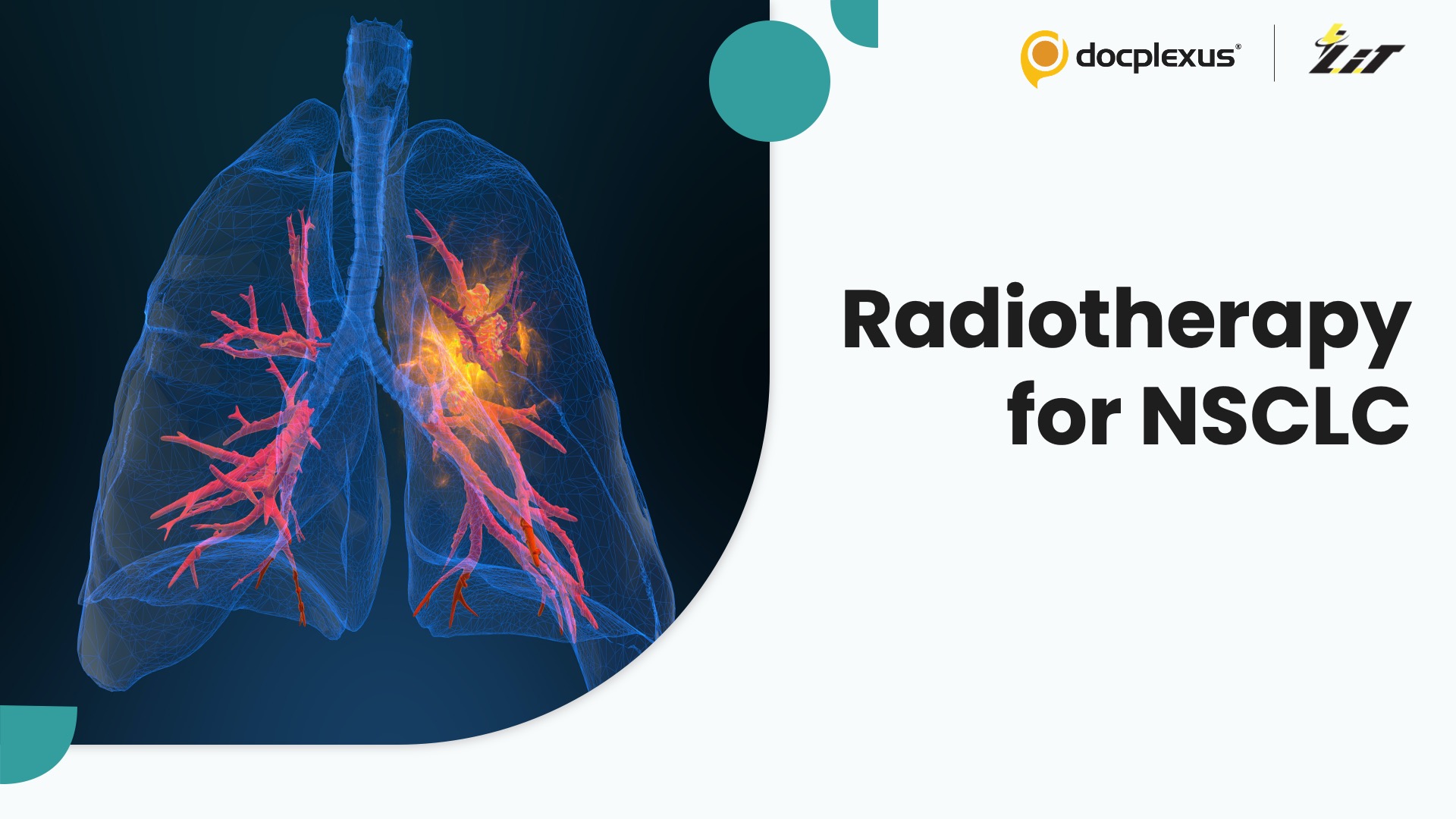 Can Radiotherapy Replace Surgery in Early Lung Cancer?