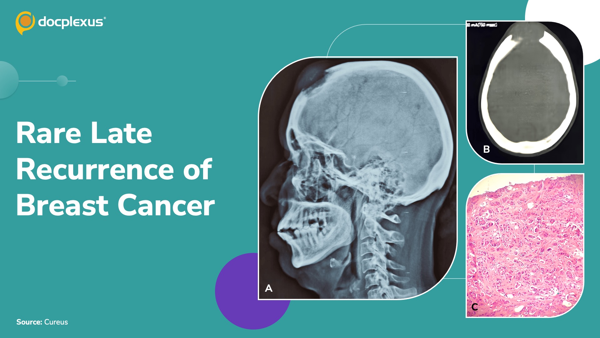 From Remission to Recurrence: When Breast Cancer Returns After a Decade