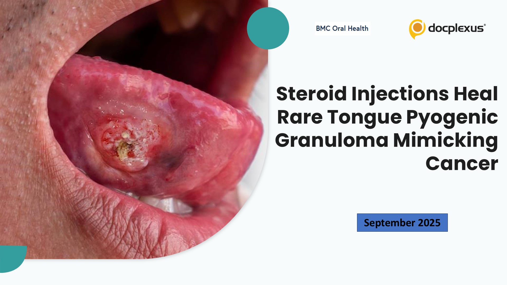 Steroid Injections Heal Rare Tongue Pyogenic Granuloma Mimicking Cancer