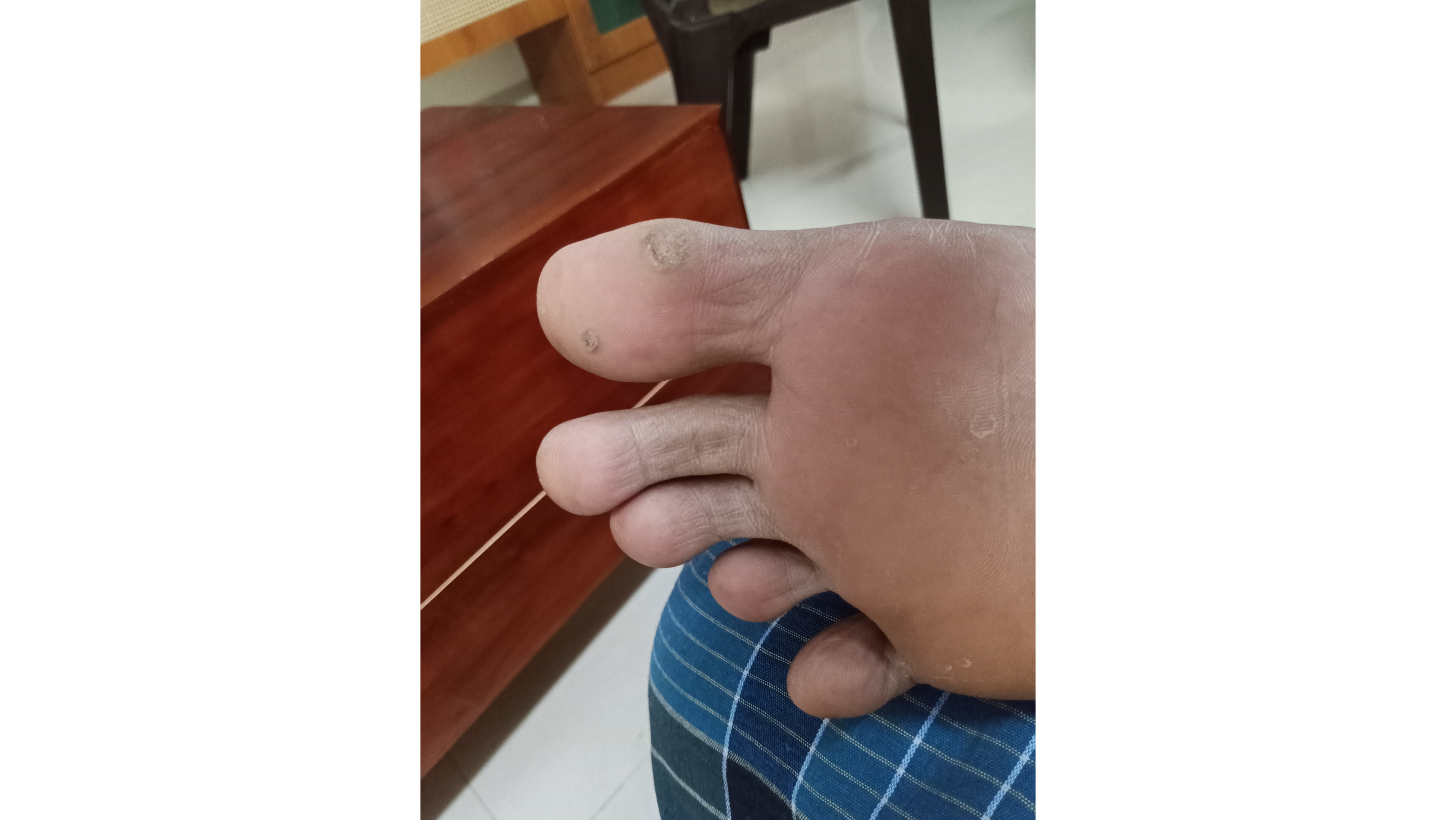Plantar Lesions in a Pre-diabetic Patient