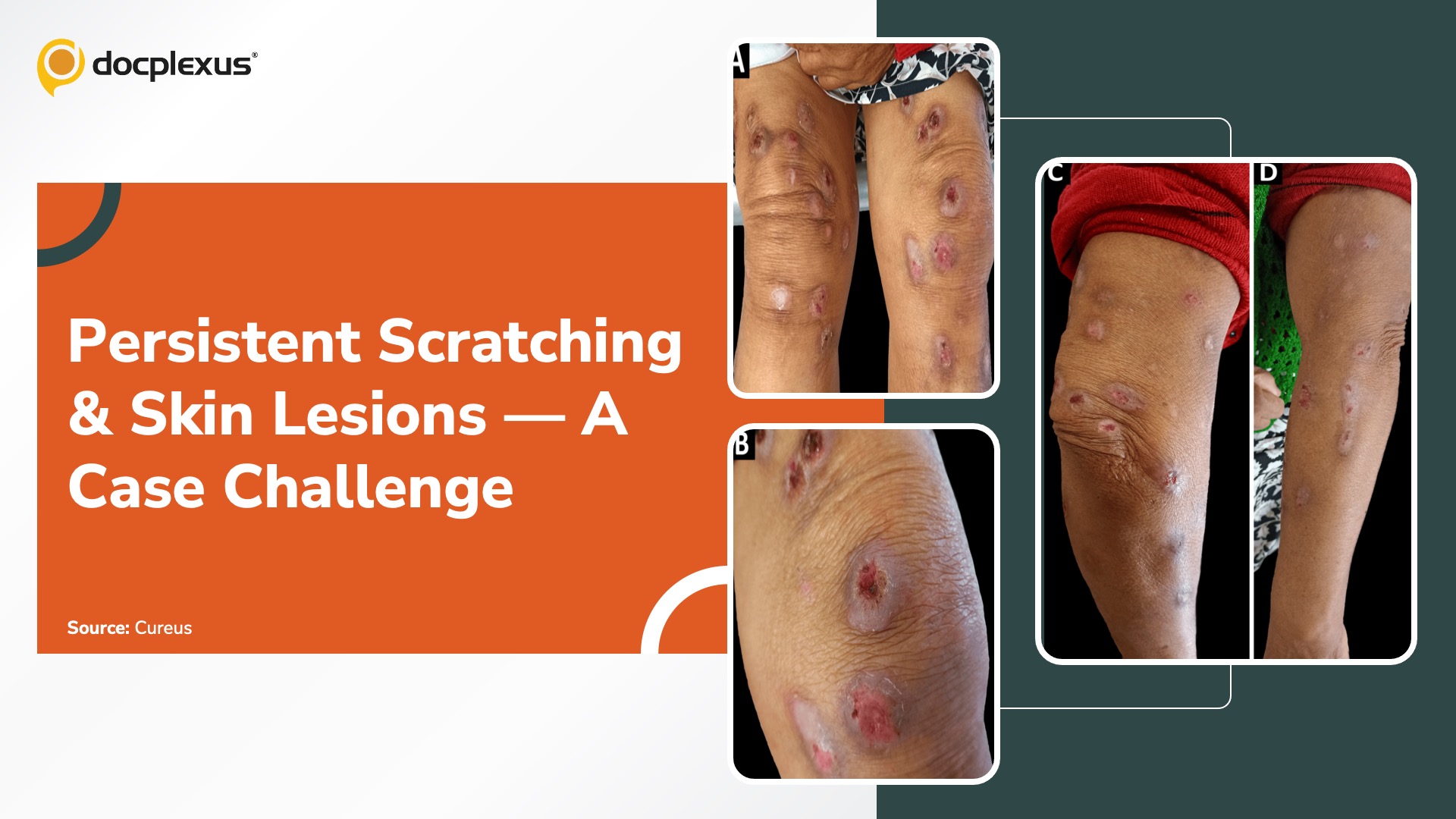 A Case of Persistent Scratching and Skin Lesions