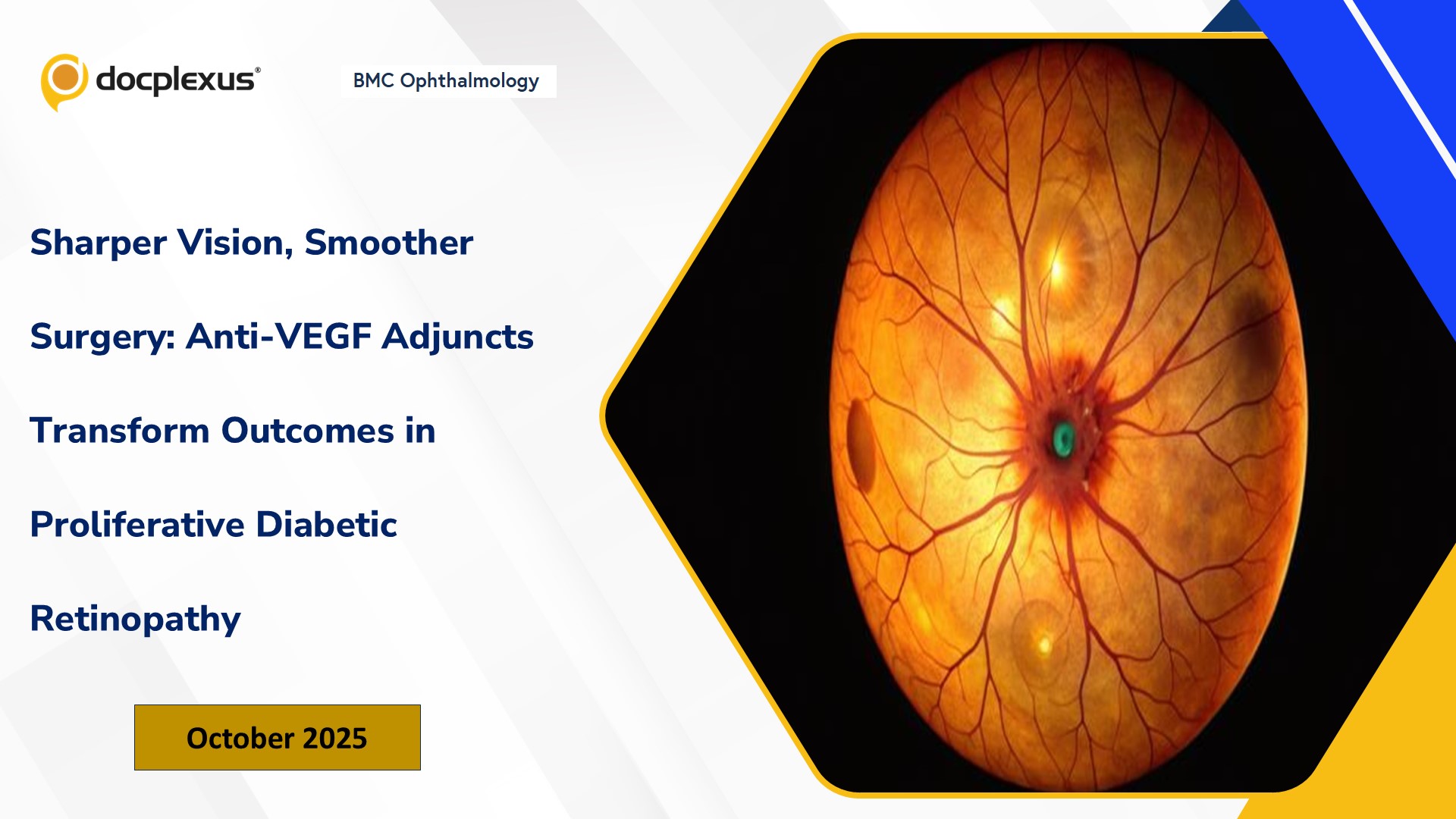 Sharper Vision, Smoother Surgery: Anti-VEGF Adjuncts Transform Outcomes in Proliferative Diabetic Retinopathy