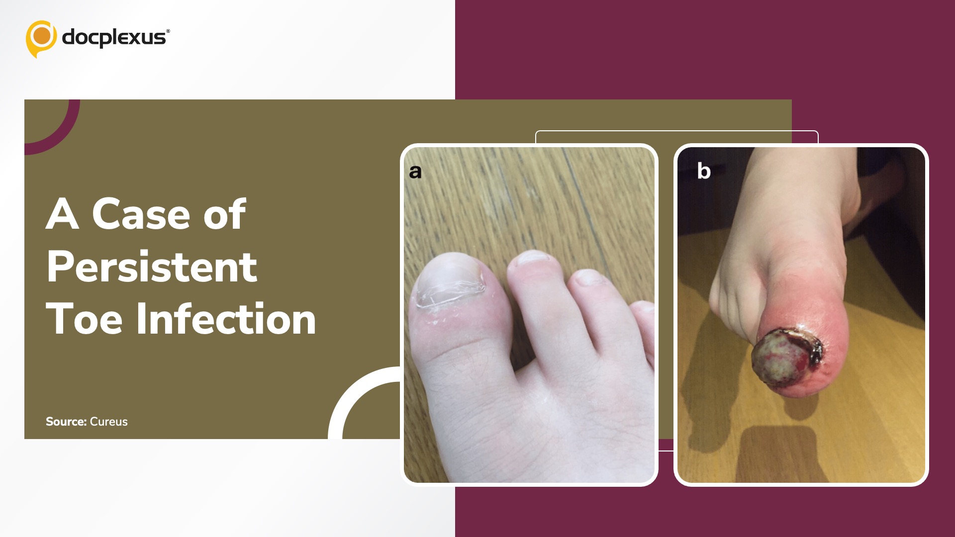 When a Minor Toe Injury Turns Serious: What’s Your Diagnosis?