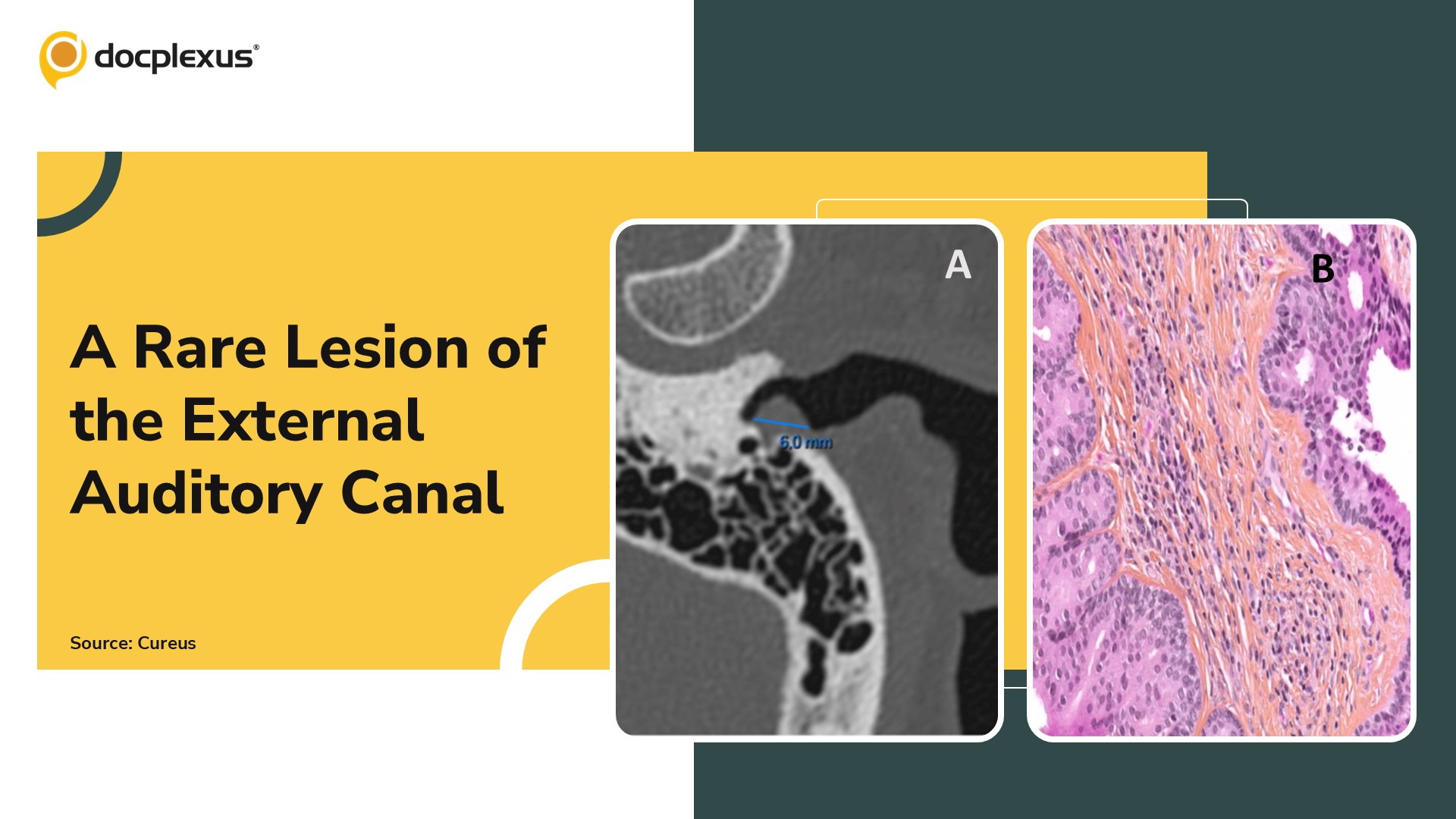 Diagnosis This Rare Lesion of the External Auditory Canal