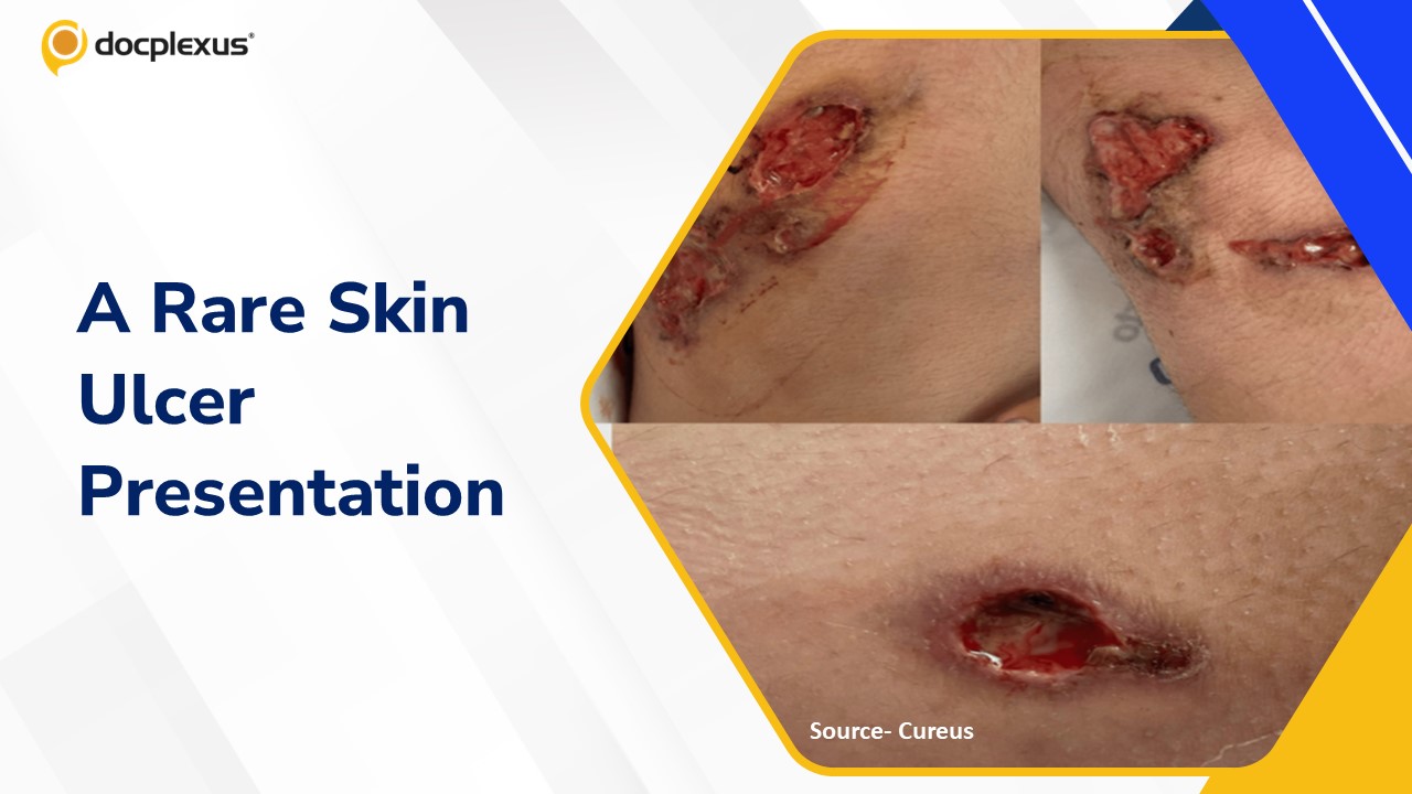 Unusual Skin Ulcers: Navigating the Diagnostic Maze