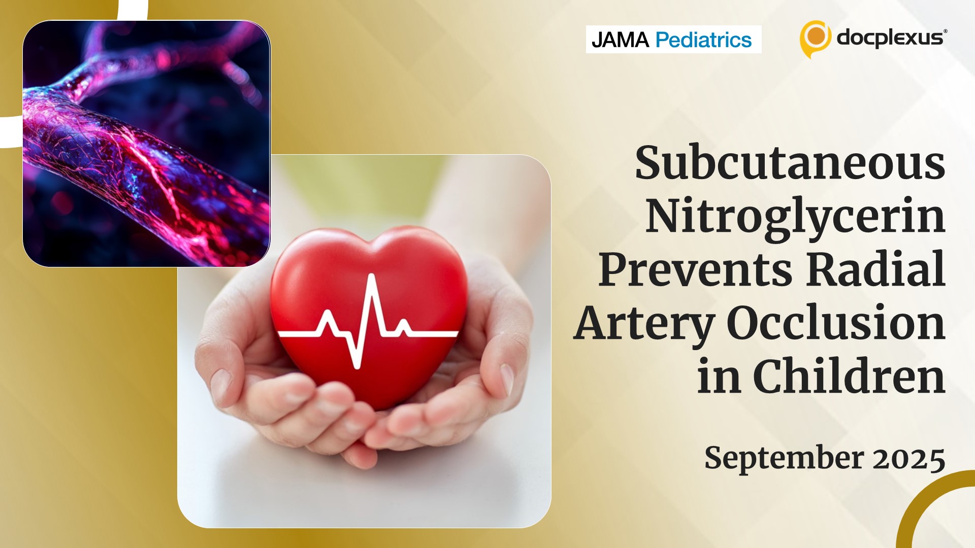 Can Subcutaneous Nitroglycerin Prevent Radial Artery Occlusion in Children?