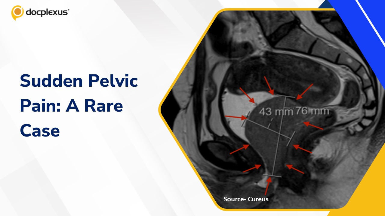 A Rare Twist: Sudden-Onset Pelvic Pain in a Young Woman